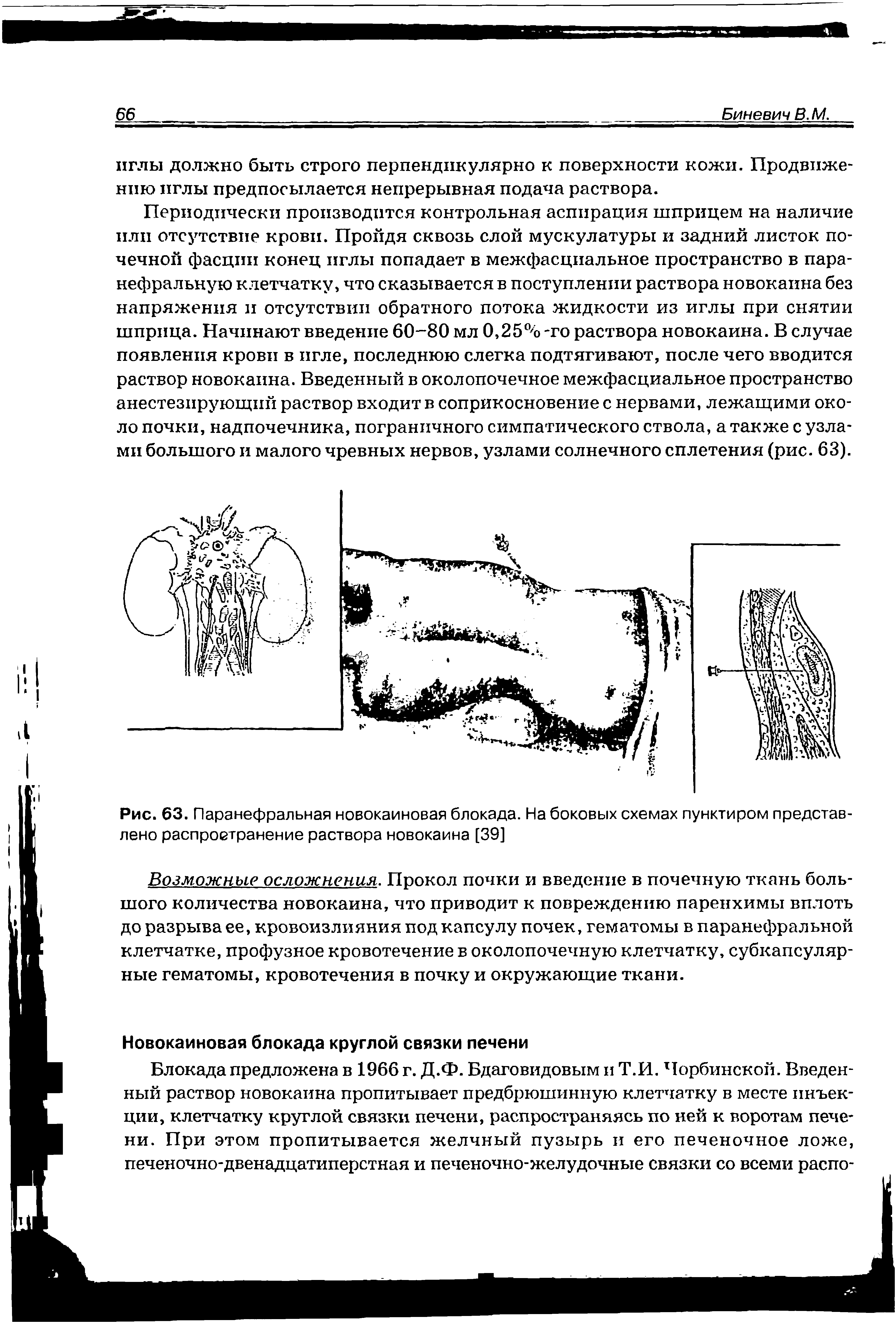 Рис. 63. Паранефральная новокаиновая блокада. На боковых схемах пунктиром представлено распространение раствора новокаина [39]...