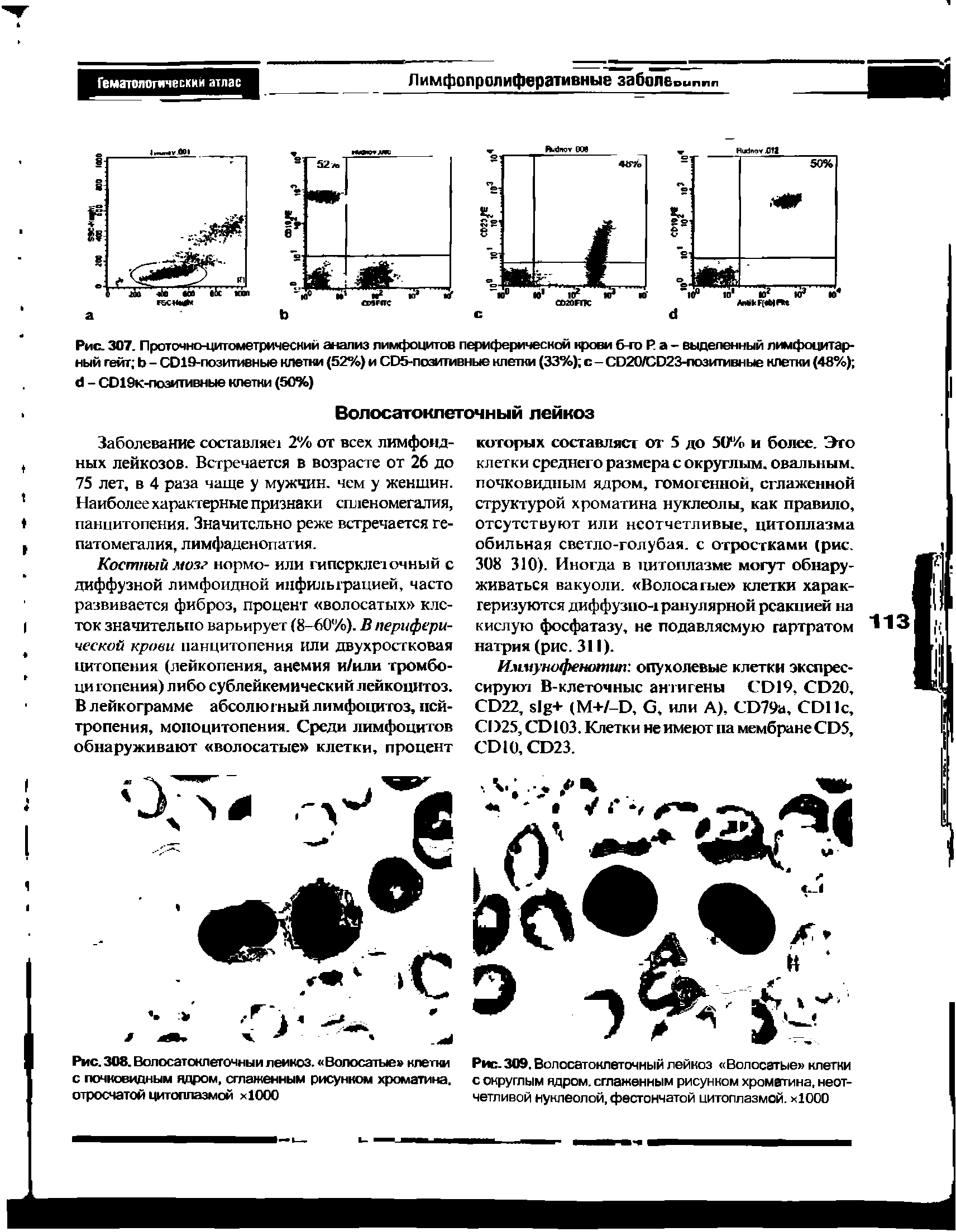 Рис. 309, Волосатоклеточный лейкоз Волосатые клетки с округлым ядром, сглаженным рисунком хроматина, неотчетливой иуклеолой, фестончатой цитоплазмой. хЮОО...