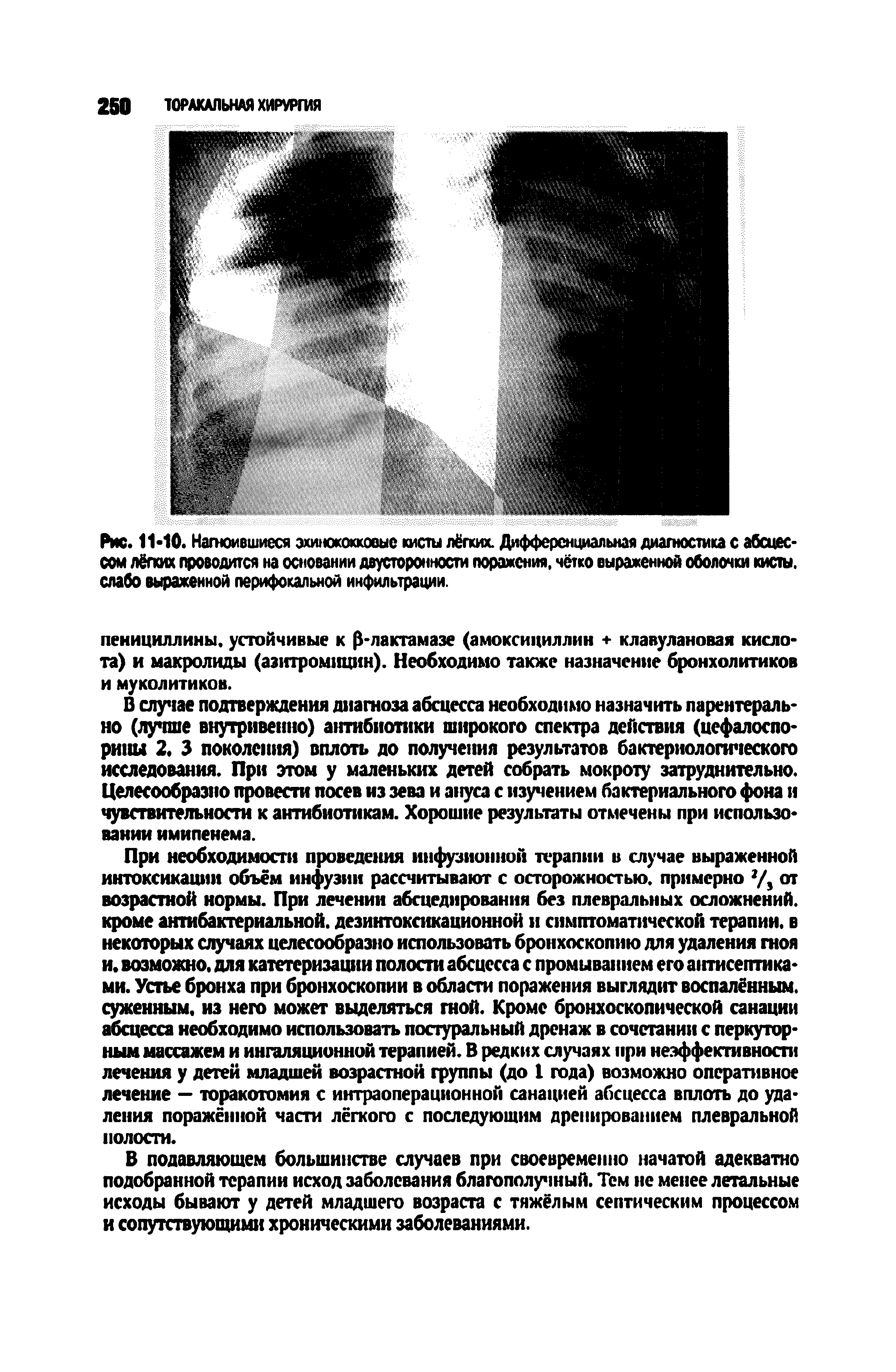 Рис. 11-10. Нагноившиеся эхинококковые кисты лёгких. Дифференциальная диагностика с абсцессом лёгких проводится на основании двусторонности поражения, чётко выраженной оболочки кисты, слабо выраженной перифокальной инфильтрации.