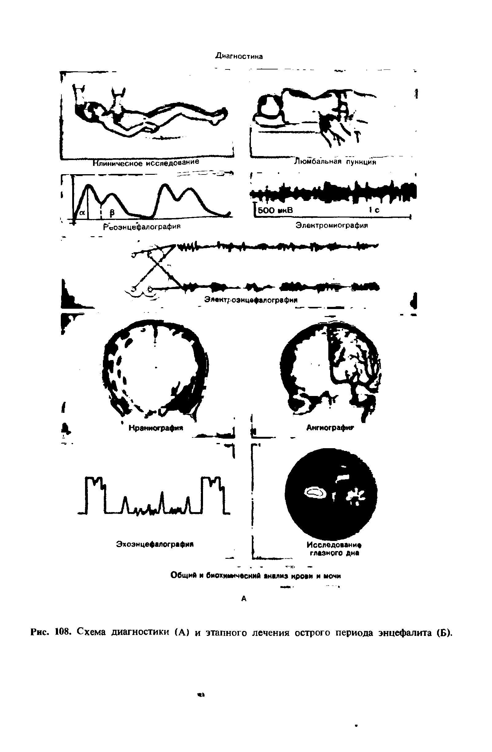 Рис. 108. Схема диагностики (А) и этапного лечения острого периода энцефалита (Б).