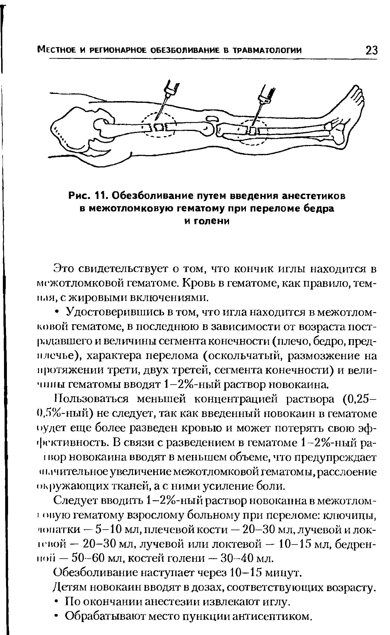 Рис. 11. Обезболивание путем введения анестетиков в межотломковую гематому при переломе бедра и голени...