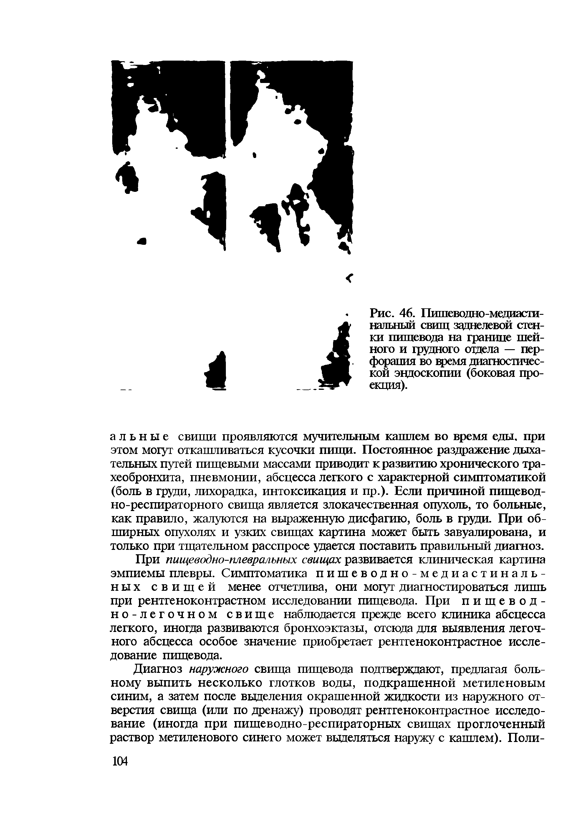 Рис. 46. Пишеводно-медиасти-нальный свищ заднелевой стенки пищевода на границе шейного и трудного отдела — перфорация во время диагностической эндоскопии (боковая проекция).