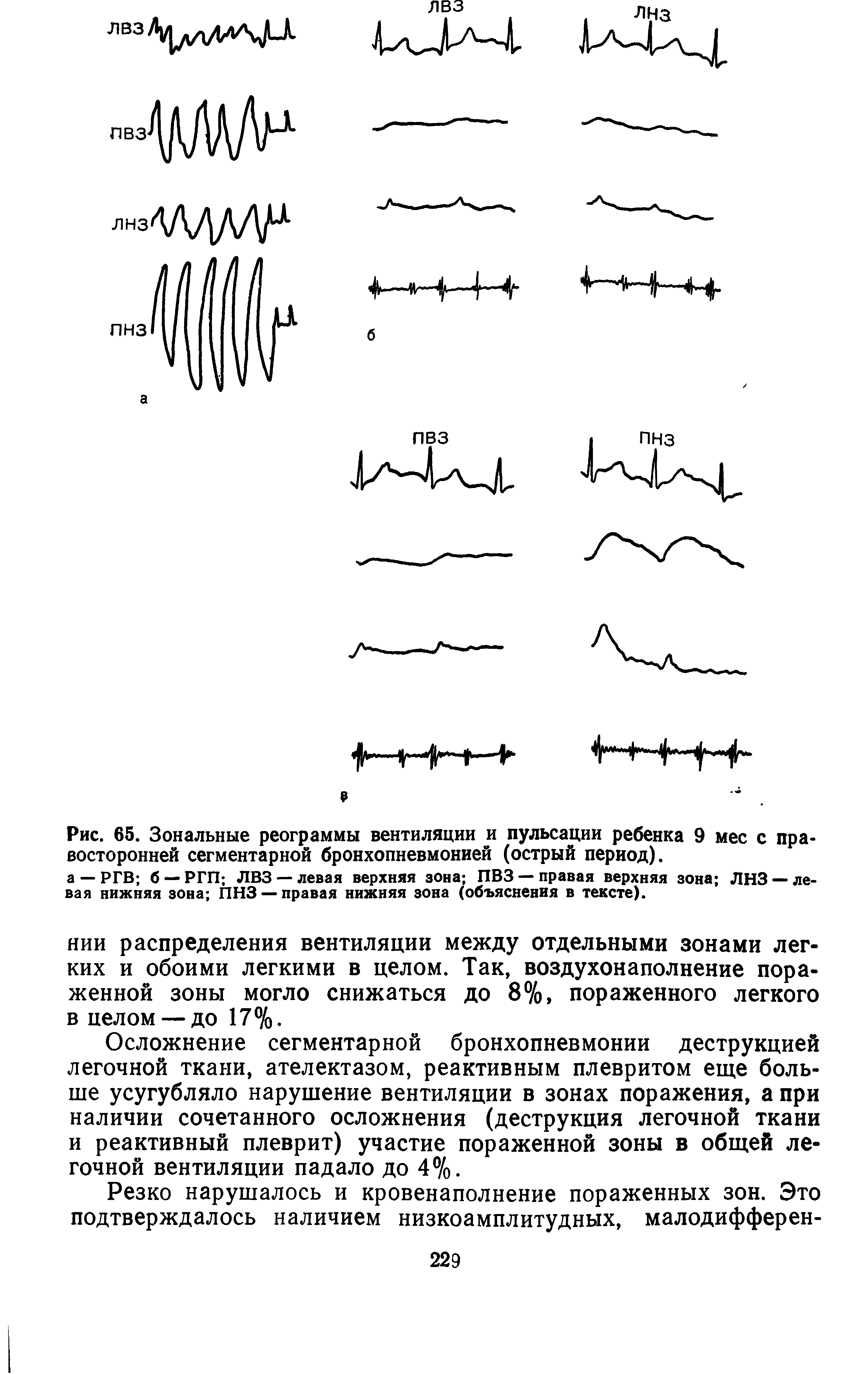 Рис. 65. Зональные реограммы вентиляции и пульсации ребенка 9 мес с правосторонней сегментарной бронхопневмонией (острый период).