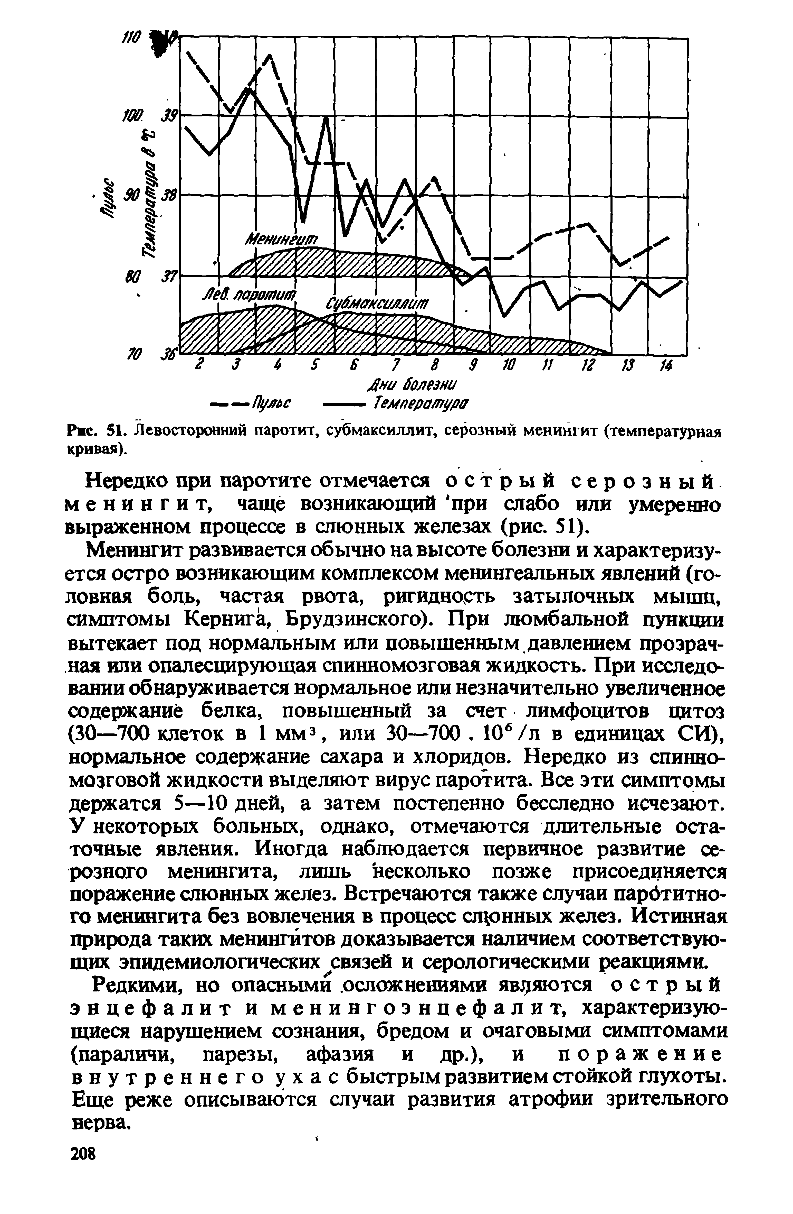 Рис. 51. Левосторонний паротит, субмаксиллит, серозный менингит (температурная кривая).