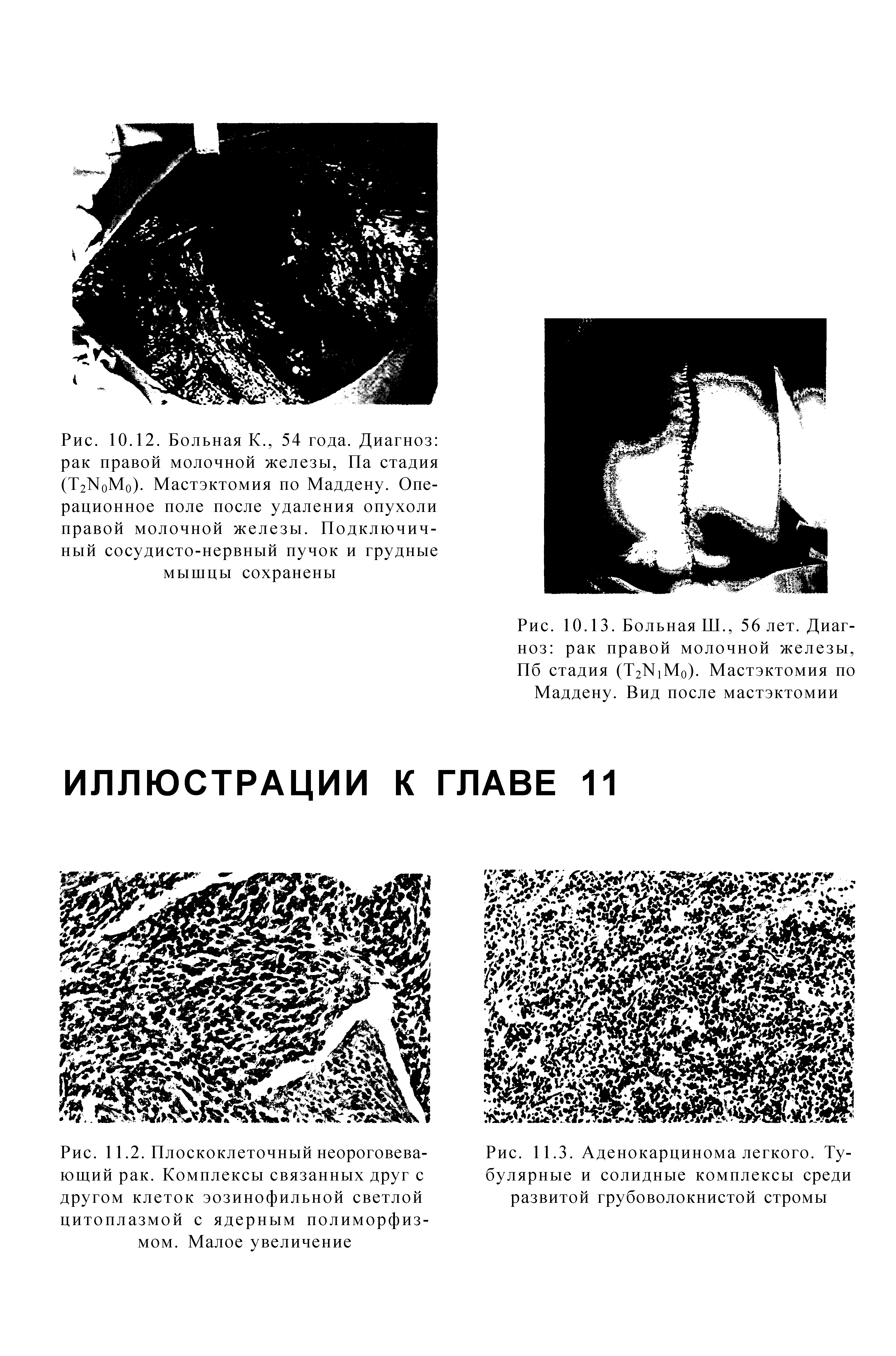 Рис. 11.3. Аденокарцинома легкого. Тубулярные и солидные комплексы среди развитой грубоволокнистой стромы...