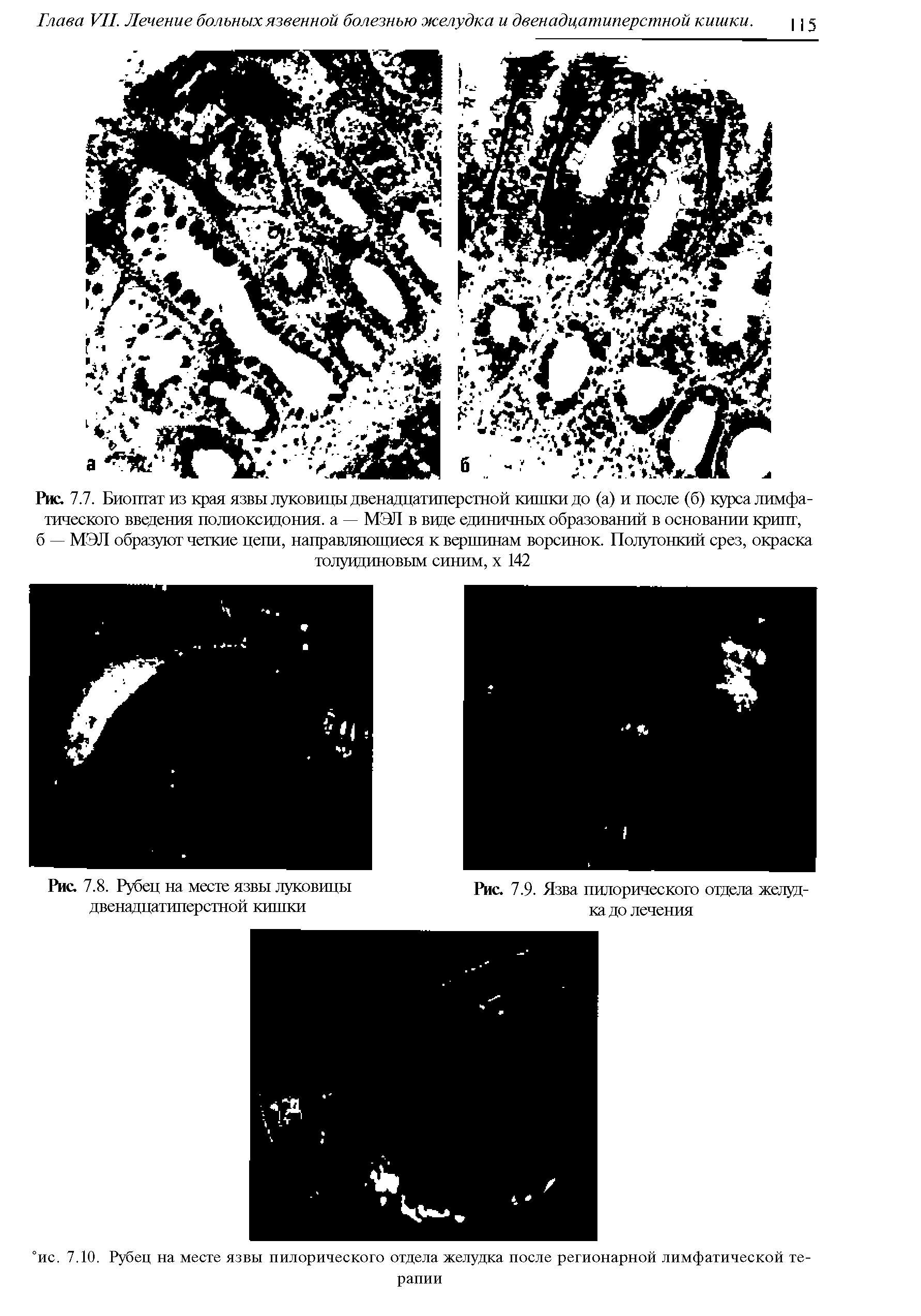 Рис. 7.7. Биоптат из края язвы луковицы двенадцатиперстной кишки до (а) и после (б) курса лимфатического введения полиоксидония. а — МЭИ в вцде единичных образований в основании крипт, б — МЭЛ образуют четкие цепи, направляющиеся к вершинам ворсинок. Полугонкий срез, окраска толуидиновым синим, х 142...