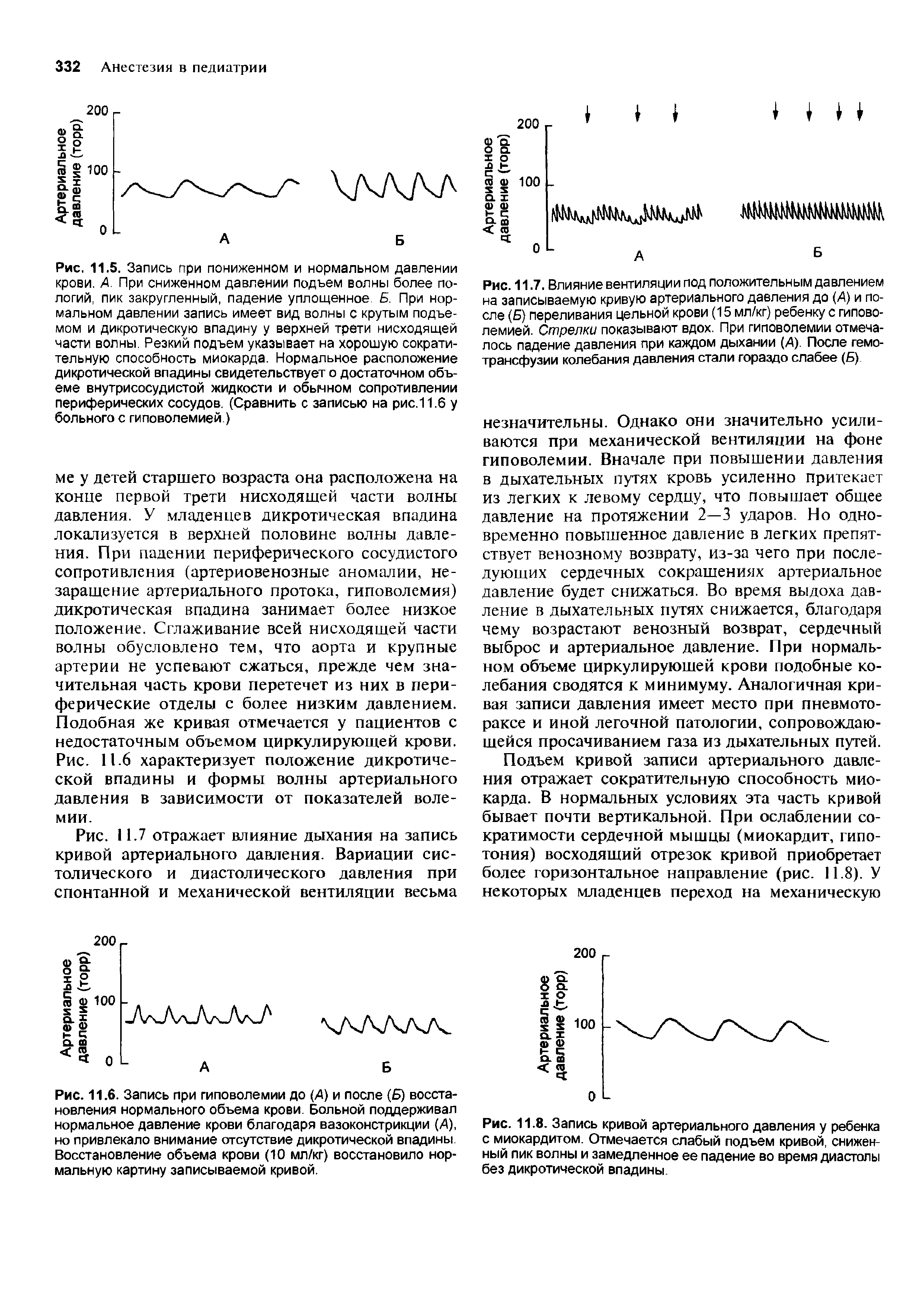 Рис. 11.6. Запись при гиповолемии до (А) и после (Б) восстановления нормального объема крови. Больной поддерживал нормальное давление крови благодаря вазоконстрикции (А), но привлекало внимание отсутствие дикротической впадины. Восстановление объема крови (10 мл/кг) восстановило нормальную картину записываемой кривой.