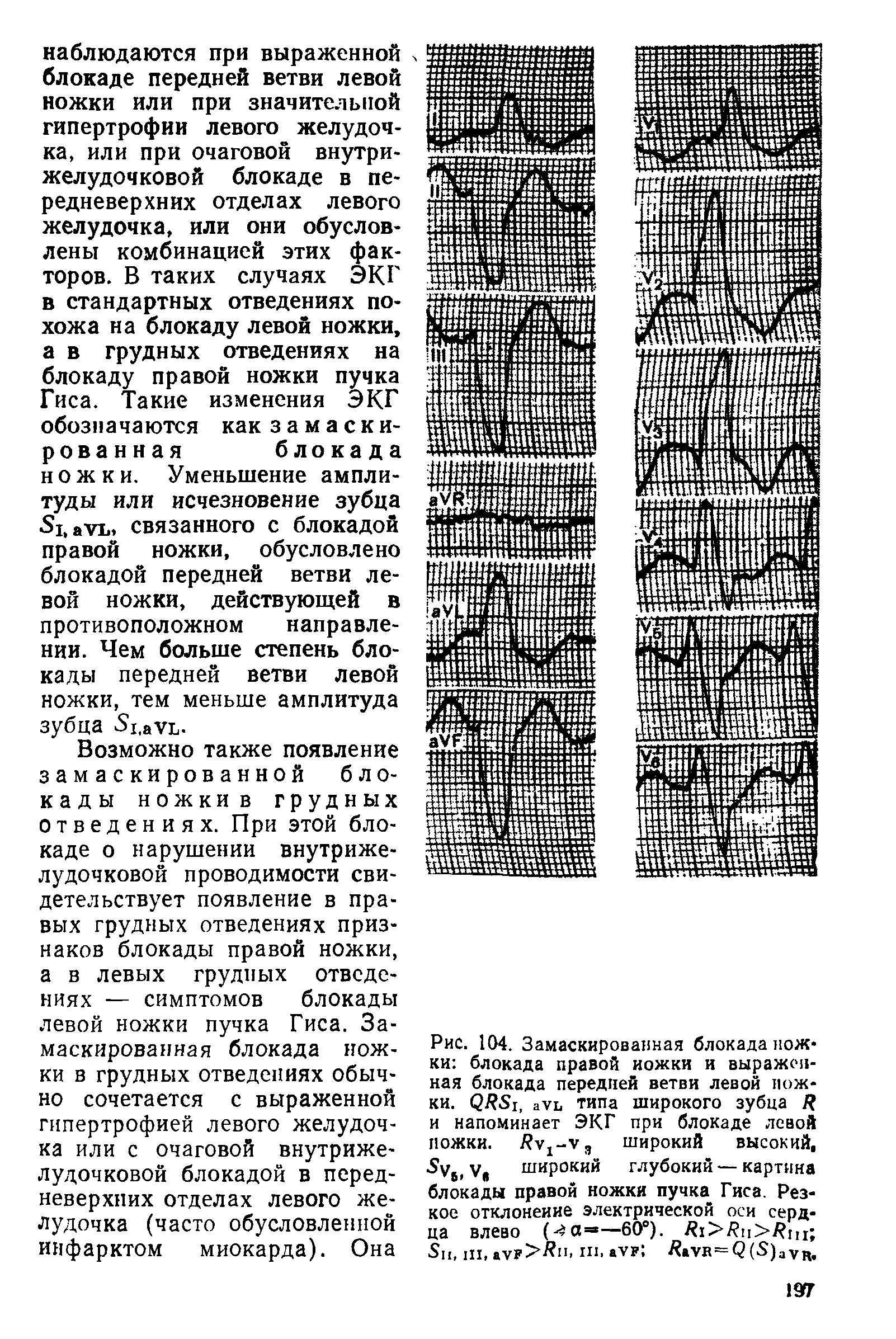 Рис. 104. Замаскированная блокада ножки блокада правой иожки и выраженная блокада передней ветви левой ножки. <2Я 1, ауп типа широкого зубца / и напоминает ЭКГ при блокаде левой ложки. Яу1-уэ широкий высокий, у6> у, широкий глубокий — картина блокады правой ножки пучка Гиса. Резкое отклонение электрической оси сердца влево (- а=—60°). / 1>/ п>/ ш 11, III, аУ >Лп, III, аУ ЯаУВ = < ( )ауц.