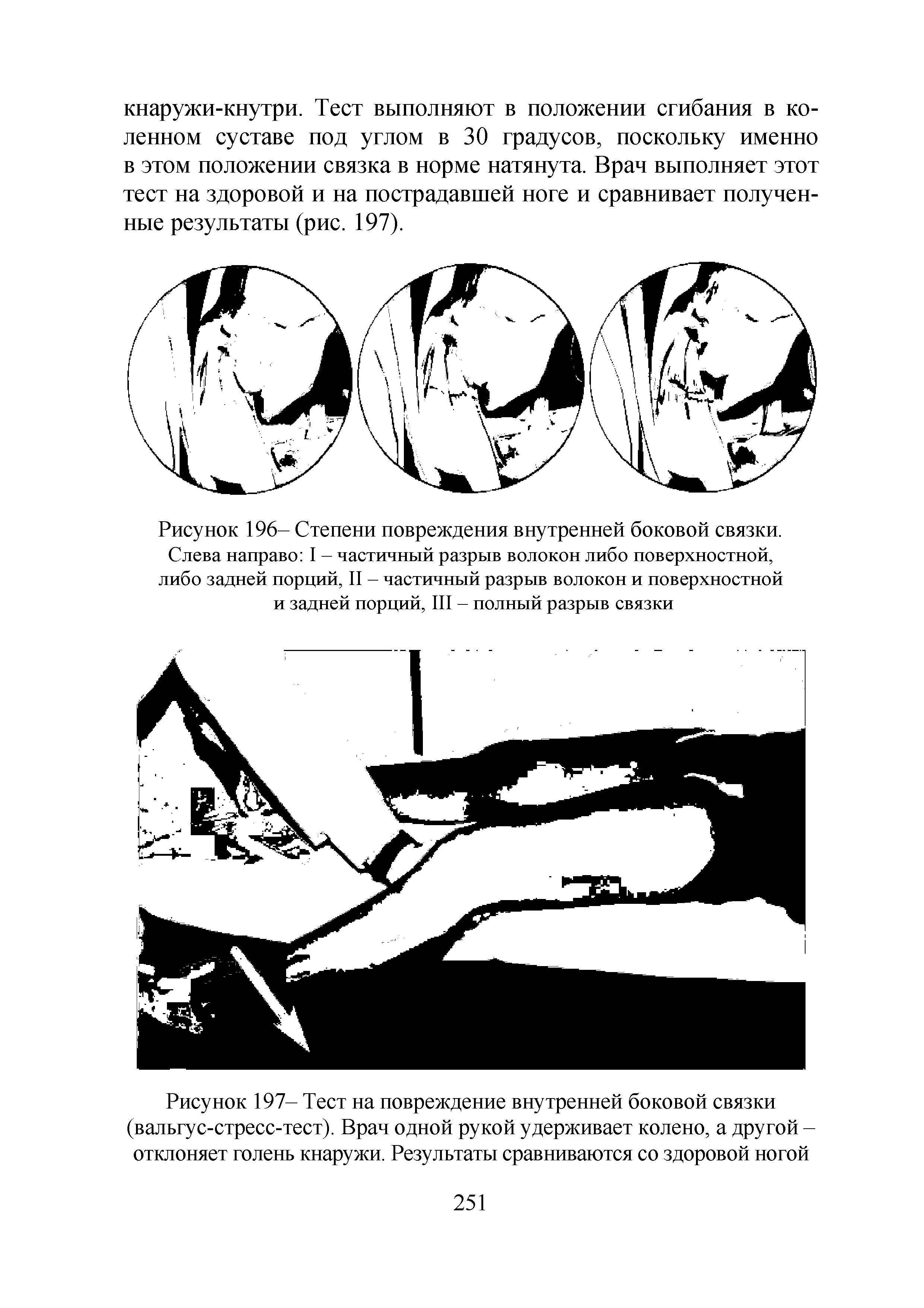 Рисунок 196- Степени повреждения внутренней боковой связки. Слева направо I - частичный разрыв волокон либо поверхностной, либо задней порций, II - частичный разрыв волокон и поверхностной и задней порций, III - полный разрыв связки...