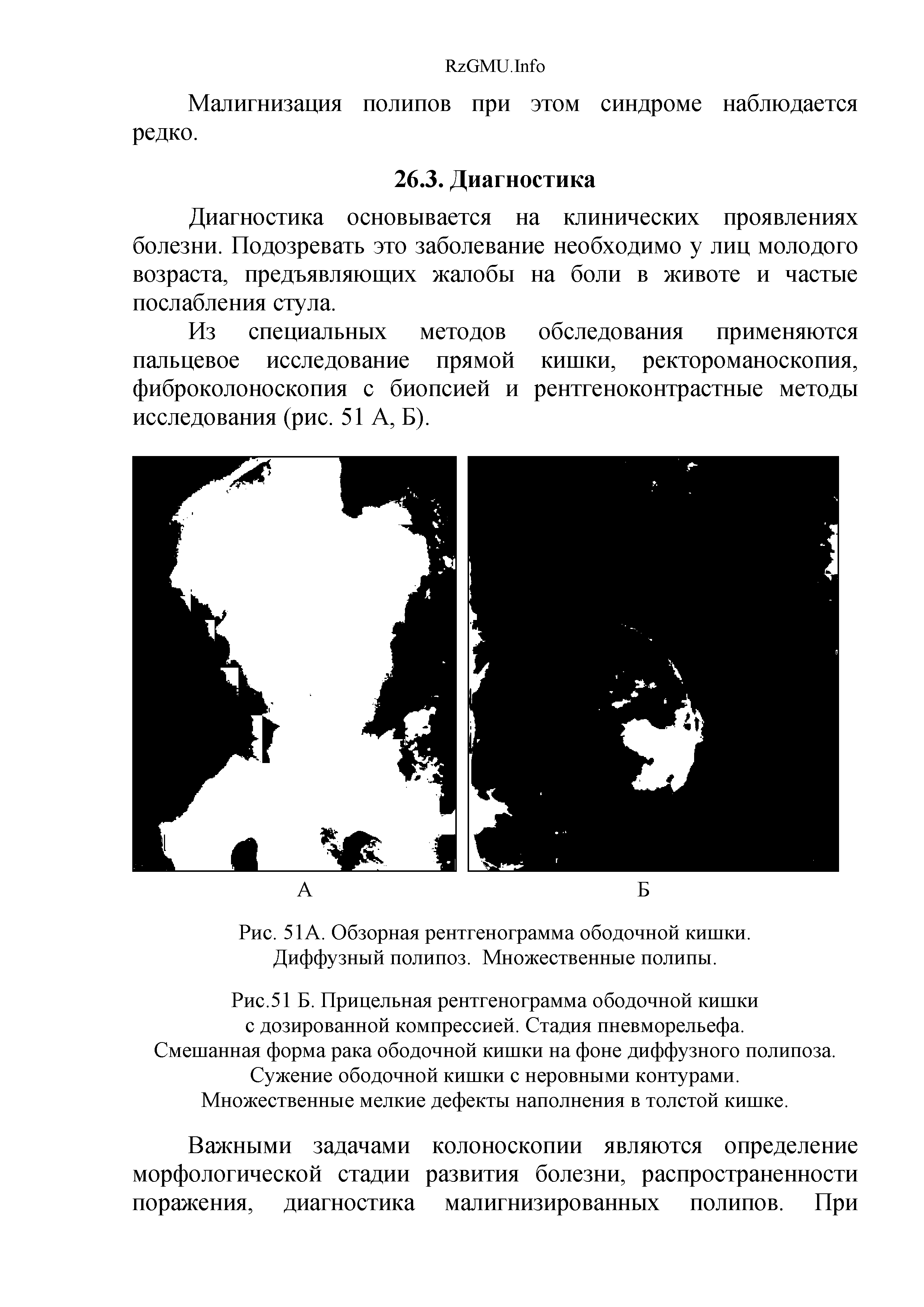 Рис. 51 А. Обзорная рентгенограмма ободочной кишки. Диффузный полипоз. Множественные полипы.