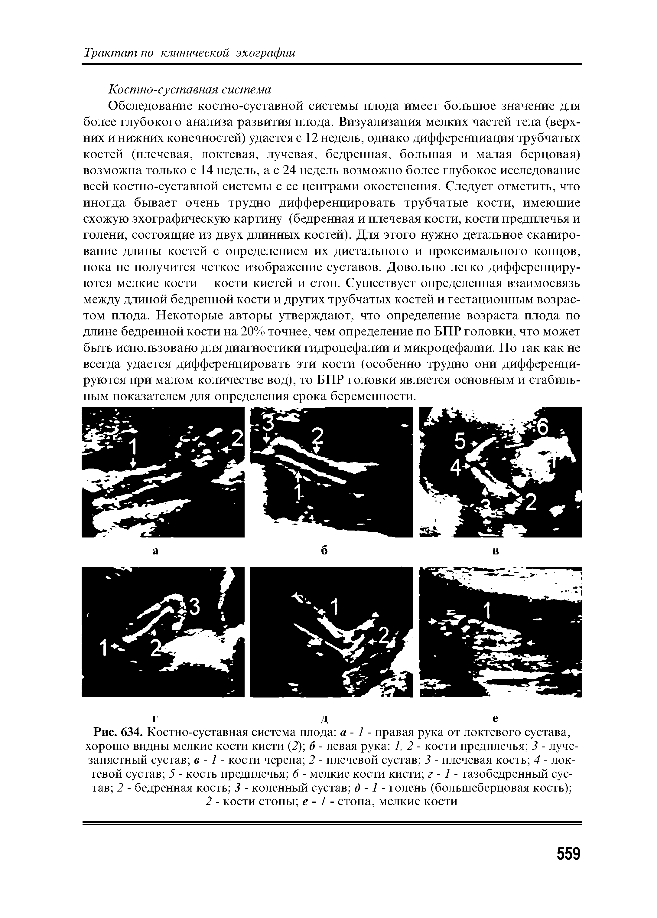 Рис. 634. Костно-суставная система плода а - 1 - правая рука от локтевого сустава, хорошо видны мелкие кости кисти (2) б - левая рука 1, 2 - кости предплечья 3 - лучезапястный сустав в -1 - кости черепа 2 - плечевой сустав 3 - плечевая кость 4 - локтевой сустав 5 - кость предплечья 6 - мелкие кости кисти г - 1 - тазобедренный сустав 2 - бедренная кость 3 - коленный сустав д -1 - голень (большеберцовая кость) ...