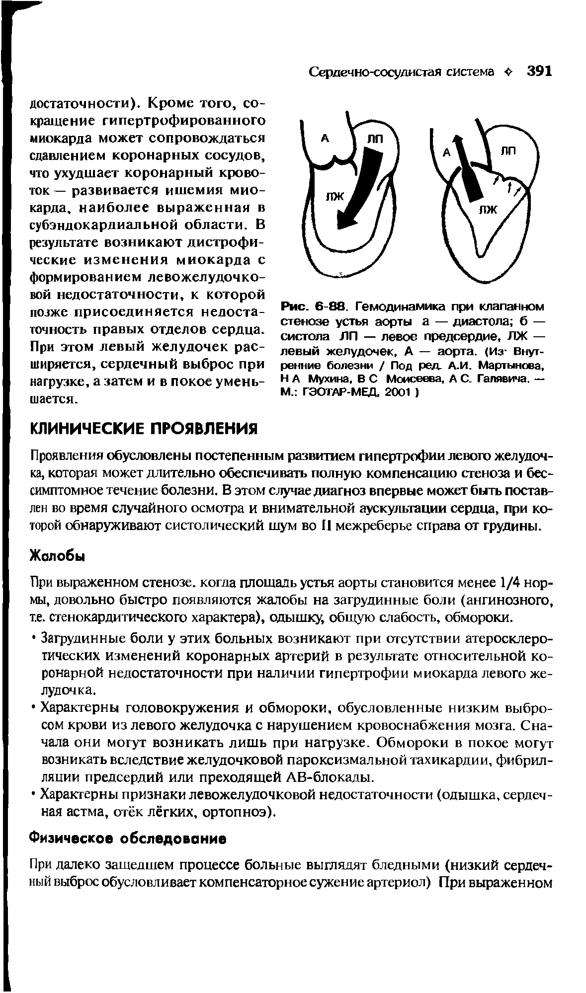 Рис. 6-88. Гемодинамика при клапанном стенозе устья аорты а — диастола б — систола ЛП — левое предсердие, ЛЖ — левый желудочек, А — аорта. (Из Внутренние болезни / Под ред. А.И. Мартынова, Н А Мухина, В С Моисеева, А С. Галявича. — М. ГЭОТАР-МЕД. 2001 )...