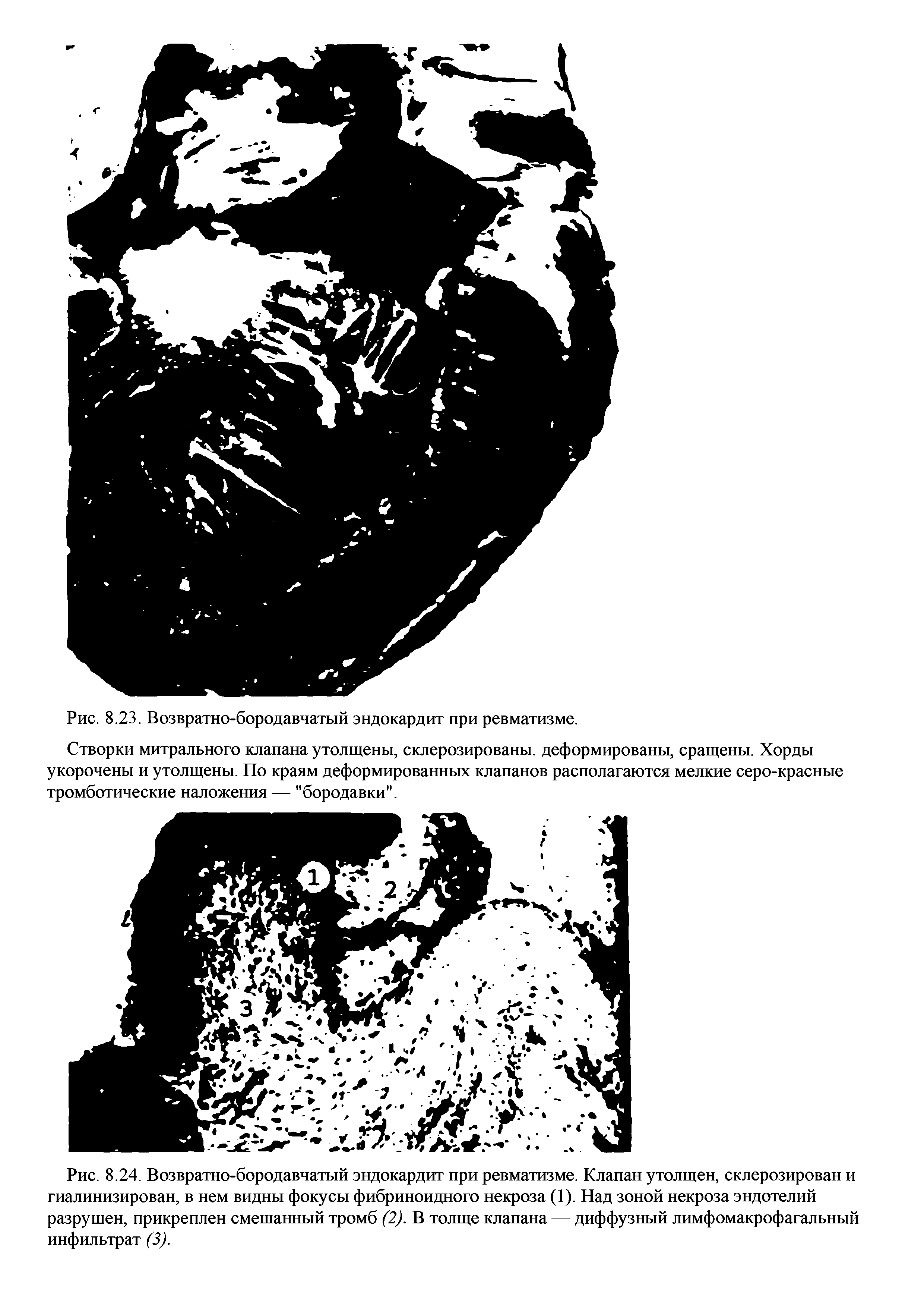 Рис. 8.24. Возвратно-бородавчатый эндокардит при ревматизме. Клапан утолщен, склерозирован и гиалинизирован, в нем видны фокусы фибриноидного некроза (1). Над зоной некроза эндотелий разрушен, прикреплен смешанный тромб (2). В толще клапана — диффузный лимфомакрофагальный инфильтрат (3).