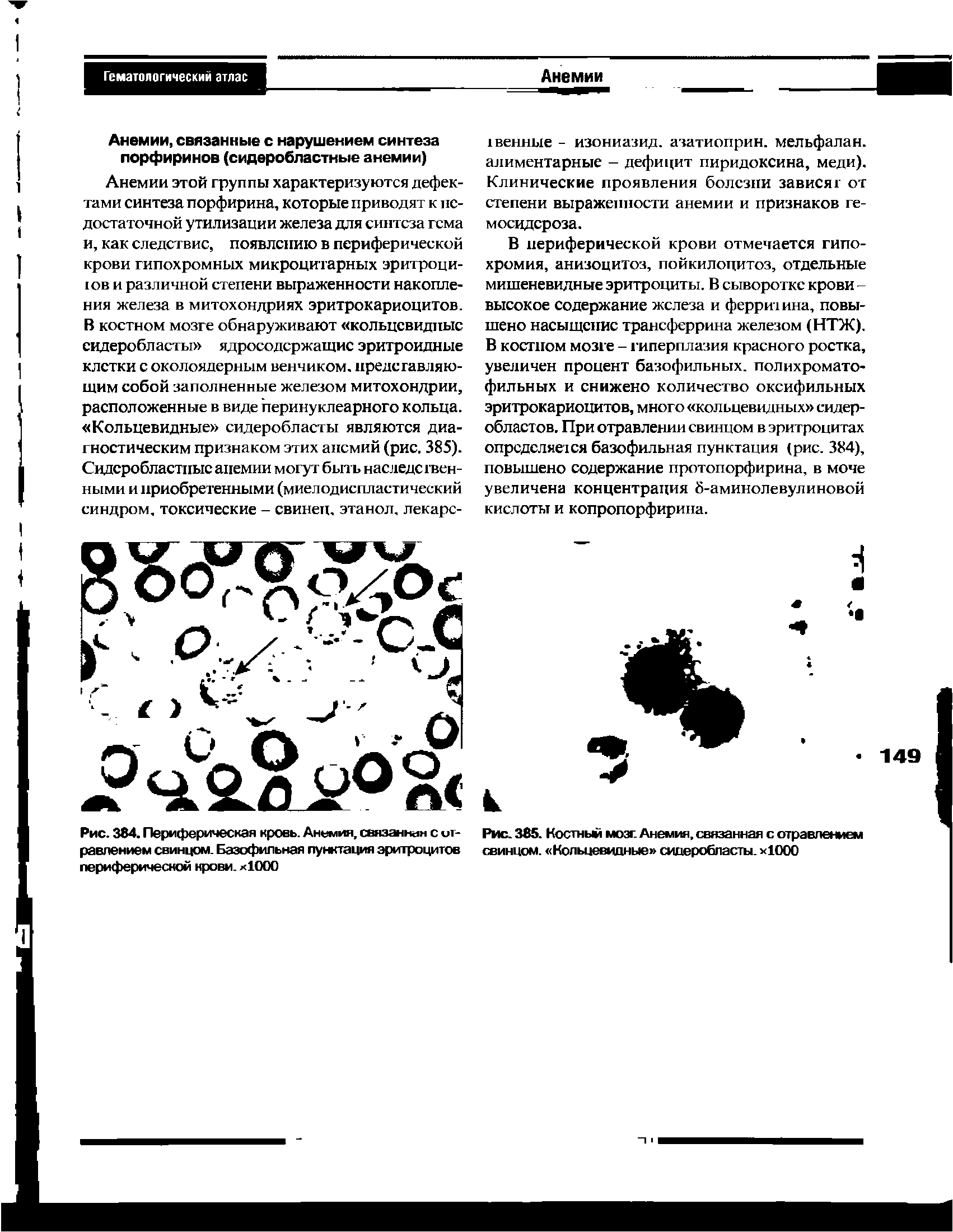 Рис. 384. Периферическая кровь. Анемия, связаннан с отравлением свинцом. Базофильная пунктация эритроцитов периферической крови. х 000...