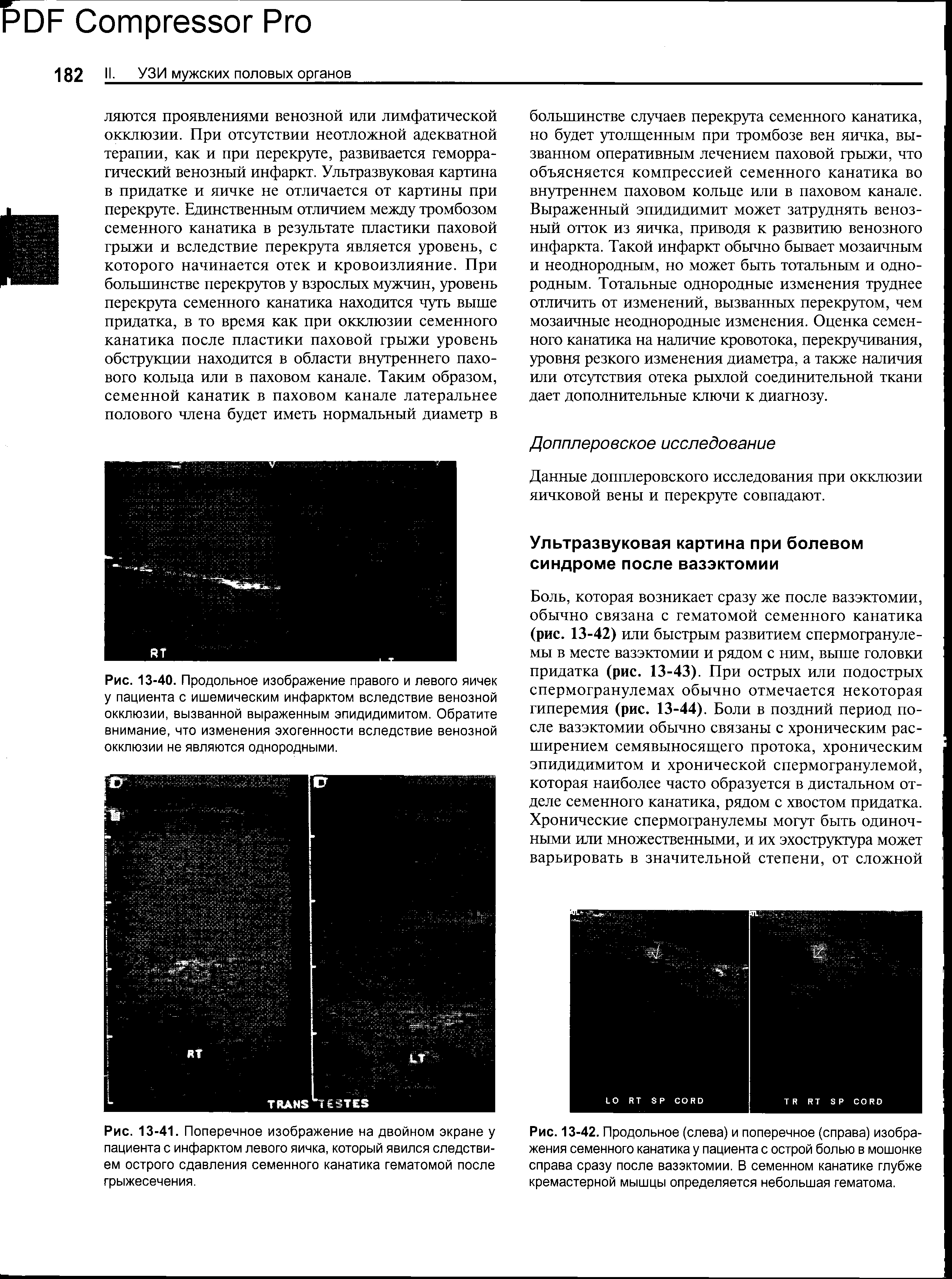 Рис. 13-41. Поперечное изображение на двойном экране у пациента с инфарктом левого яичка, который явился следствием острого сдавления семенного канатика гематомой после грыжесечения.