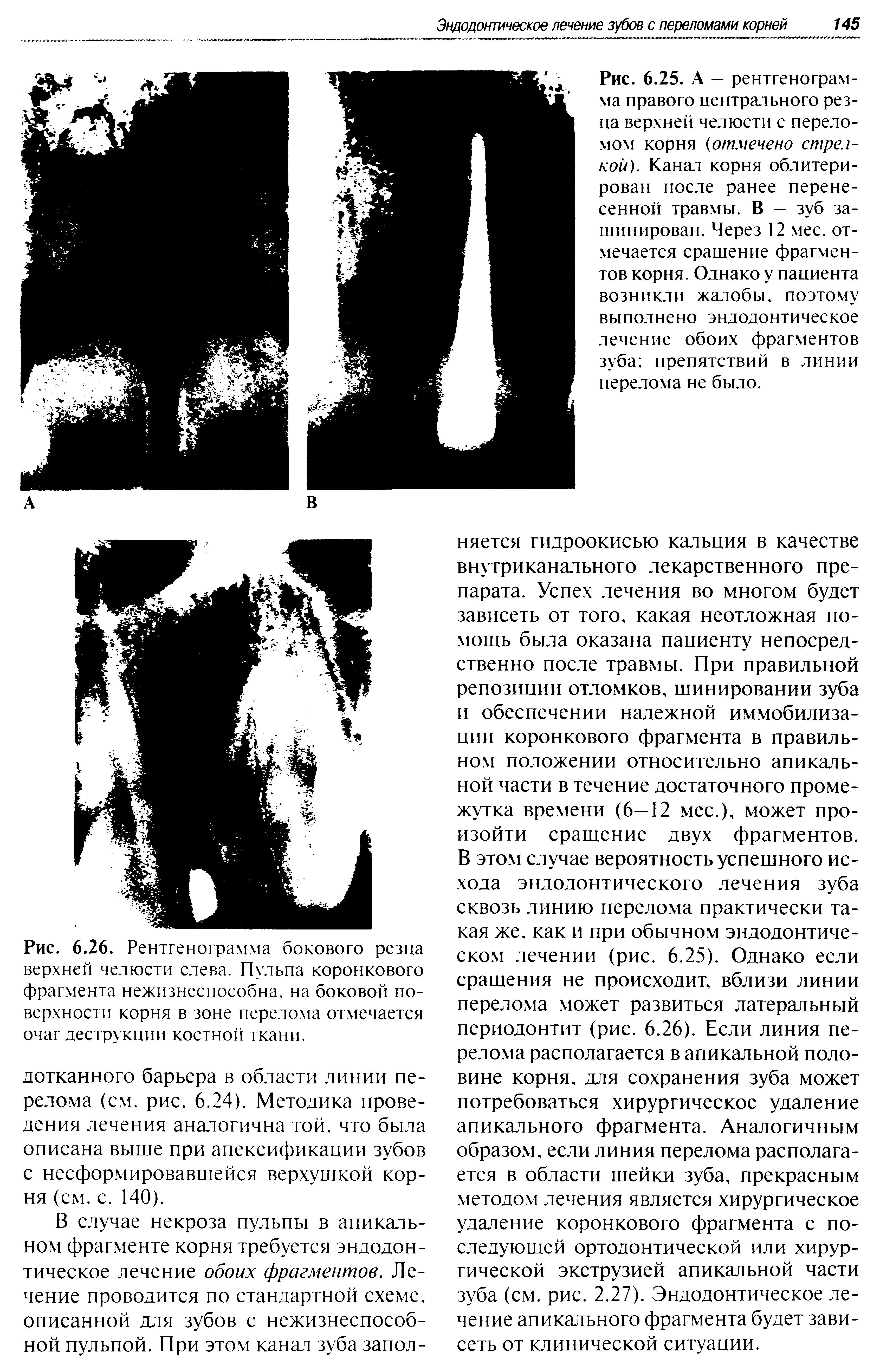 Рис. 6.26. Рентгенограмма бокового резца верхней челюсти слева. Пульпа коронкового фрагмента нежизнеспособна, на боковой поверхности корня в зоне перелома отмечается очаг деструкции костной ткани.
