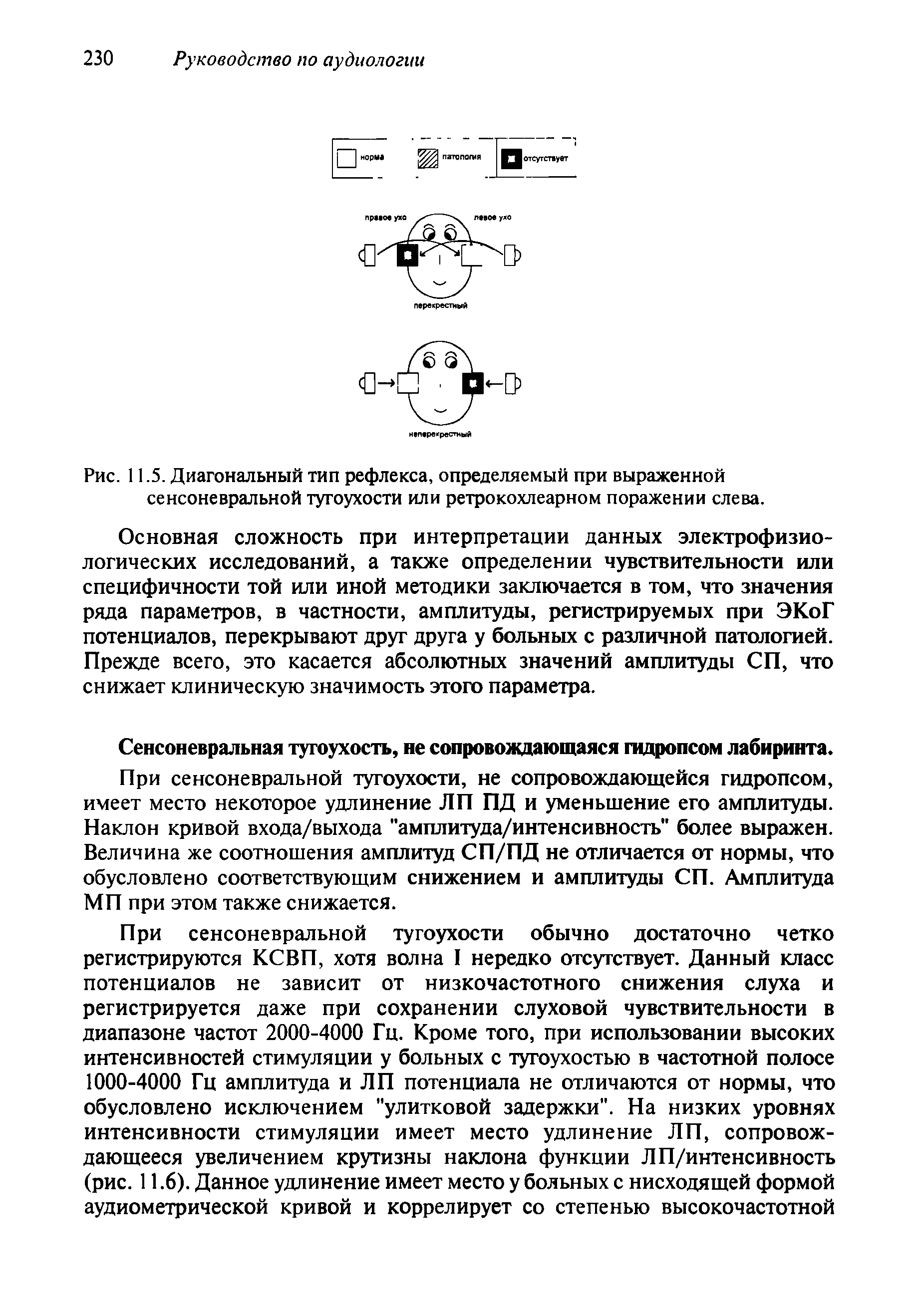 Рис. 11.5. Диагональный тип рефлекса, определяемый при выраженной сенсоневральной тугоухости или ретрокохлеарном поражении слева.