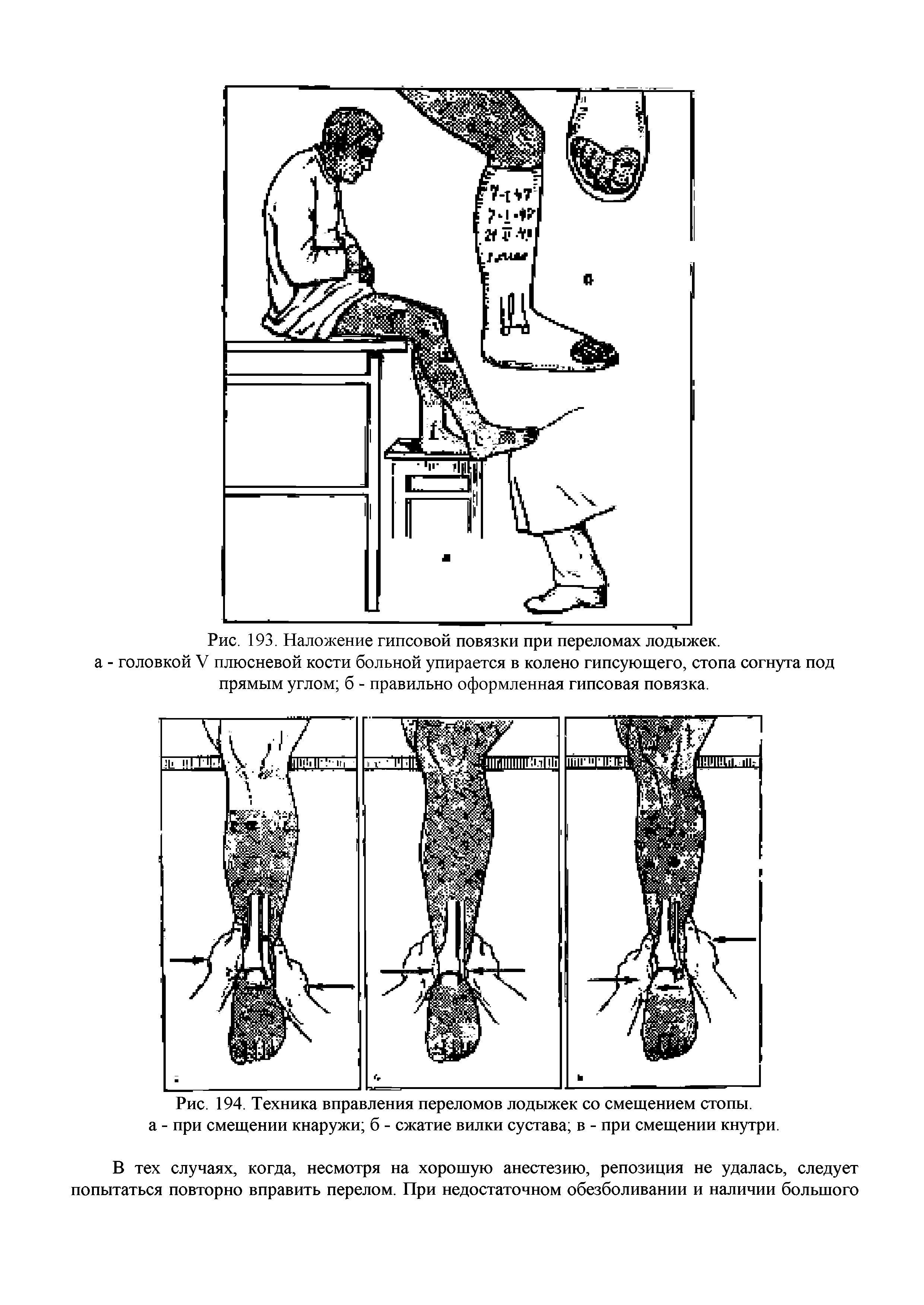 Рис. 194. Техника вправления переломов лодыжек со смещением стопы, а - при смещении кнаружи б - сжатие вилки сустава в - при смещении кнутри.