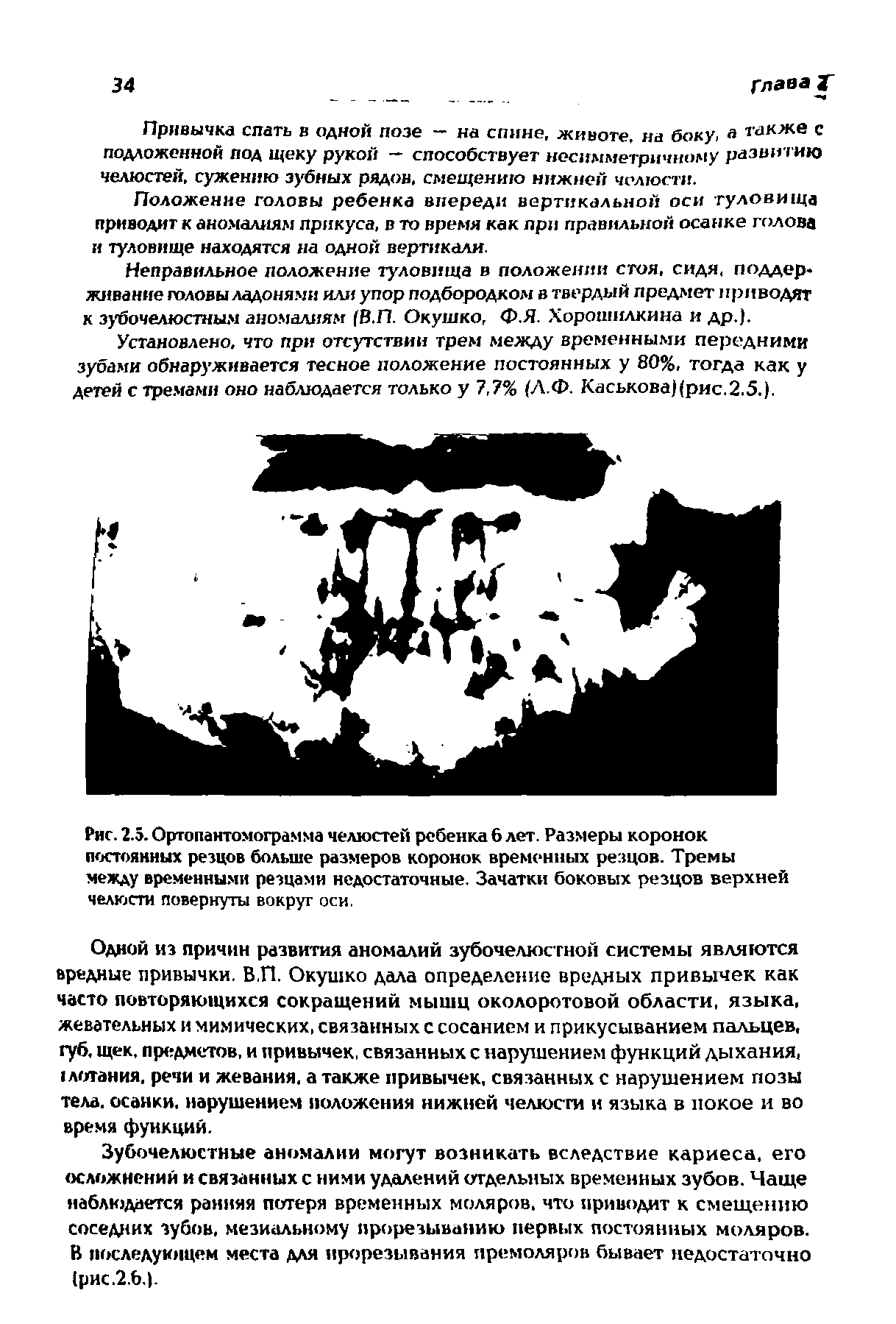 Рис. 2.5. Ортопантомограмма челюстей ребенка 6 лет. Размеры коронок постоянных резцов больше размеров коронок временных резцов. Тремы между временными резцами недостаточные. Зачатки боковых резцов верхней челюсти повернуты вокруг оси.