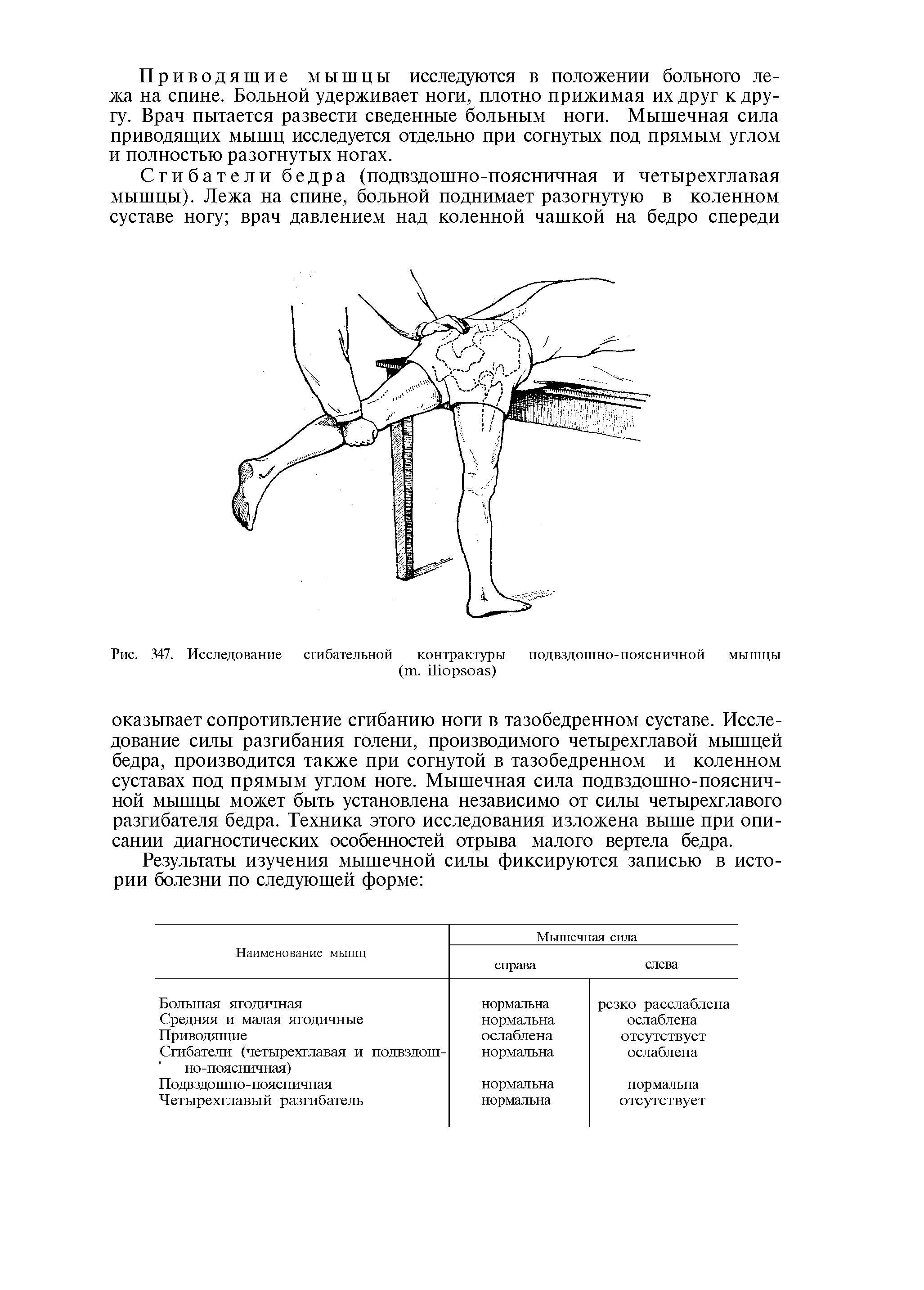 Рис. 347. Исследование сгибательной контрактуры подвздошно-поясничной мышцы ( . )...
