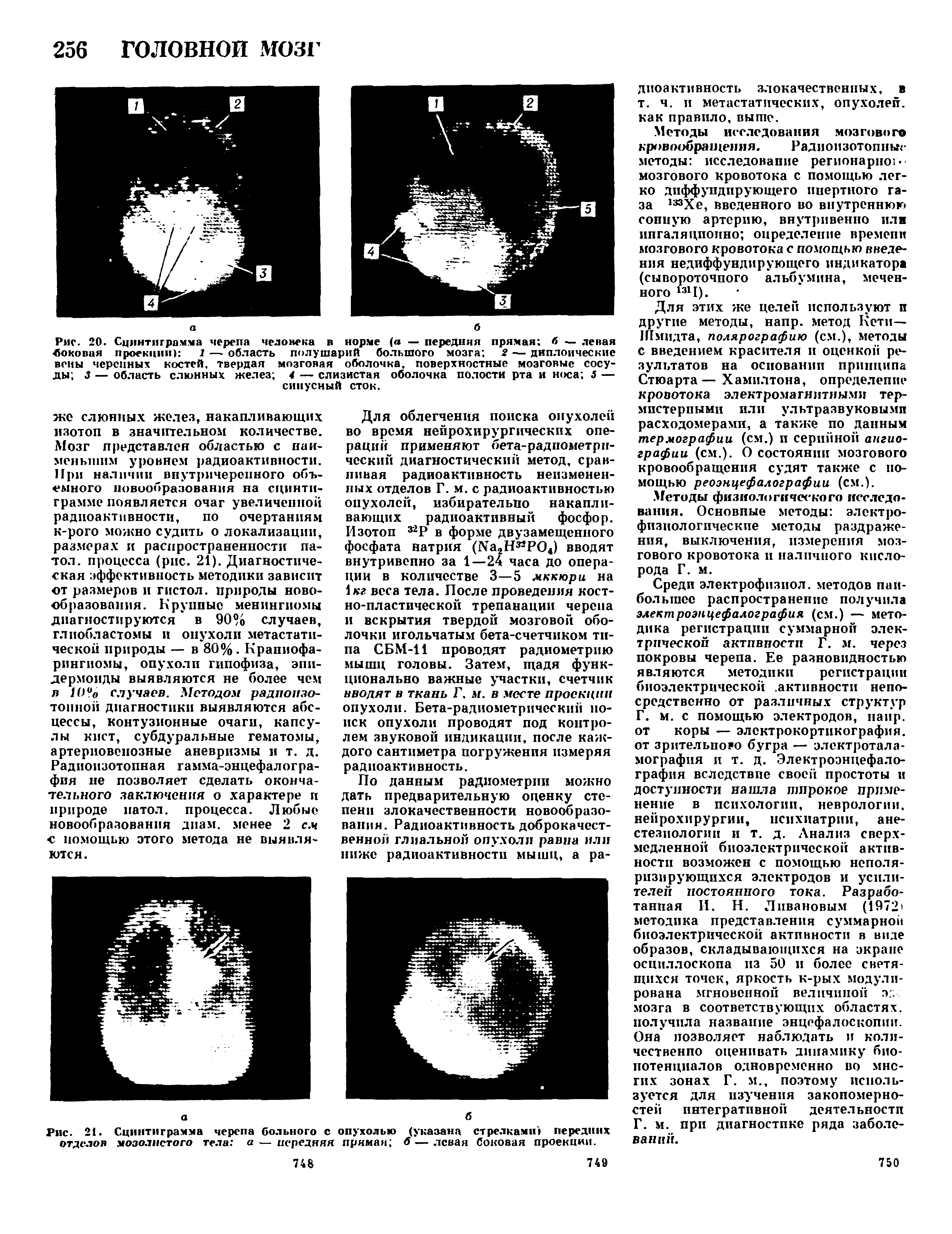 Рис. 20. Сцинтиграм.ма черепа человека в норме (а — передняя прямая, б — левая боковая проекции) 1 — область полушарий большого мозга 2 — диплоические вены черепных костей, твердая мозговая оболочка, поверхностные мозговые сосуды 3 — область слюнных желез 4 — слизистая оболочка полости рта и носа 5 — синусный сток.