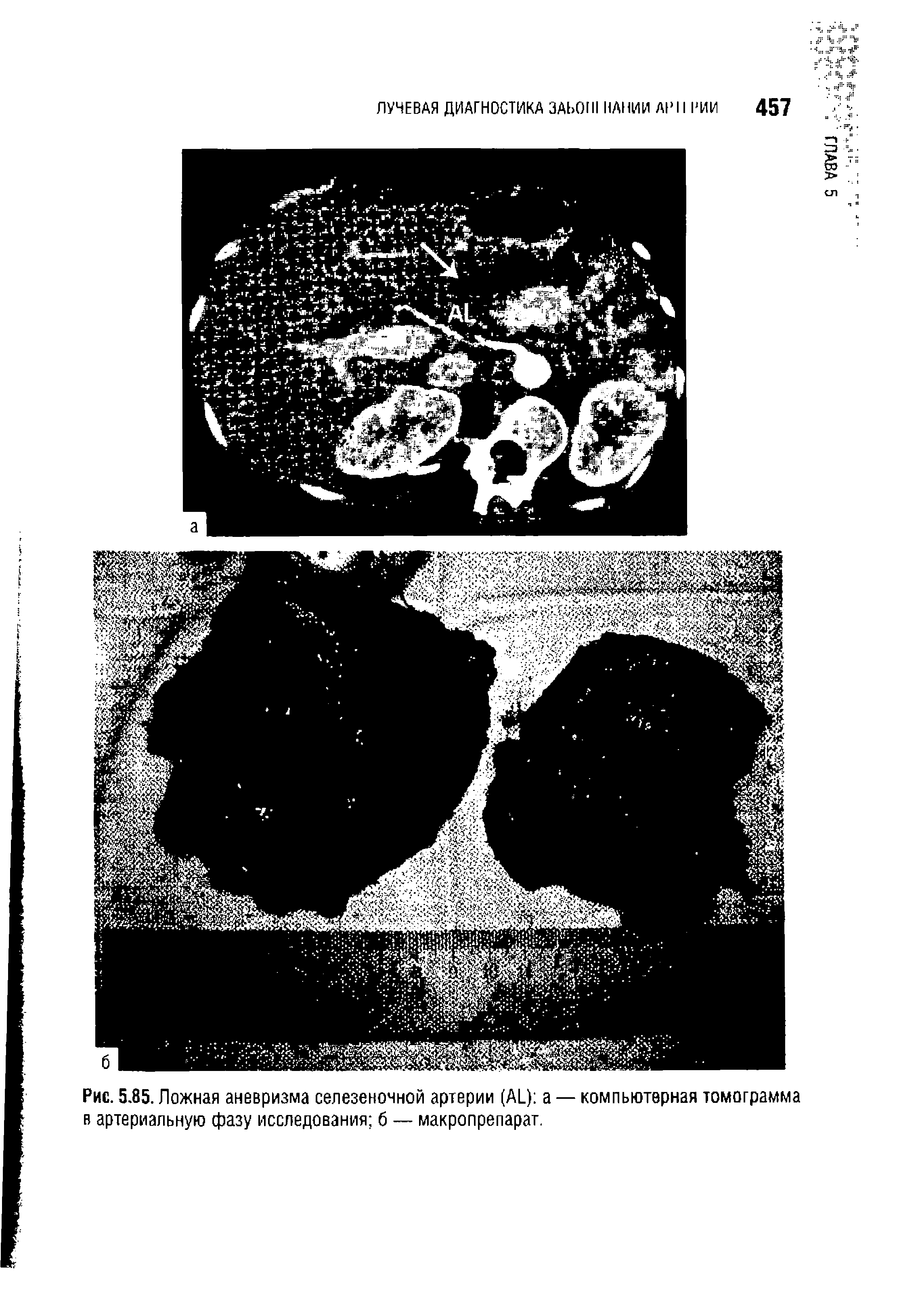 Рис. 5.85. Ложная аневризма селезеночной артерии (А1 ) а — компьютерная томограмма в артериальную фазу исследования б —- макропрепарат.