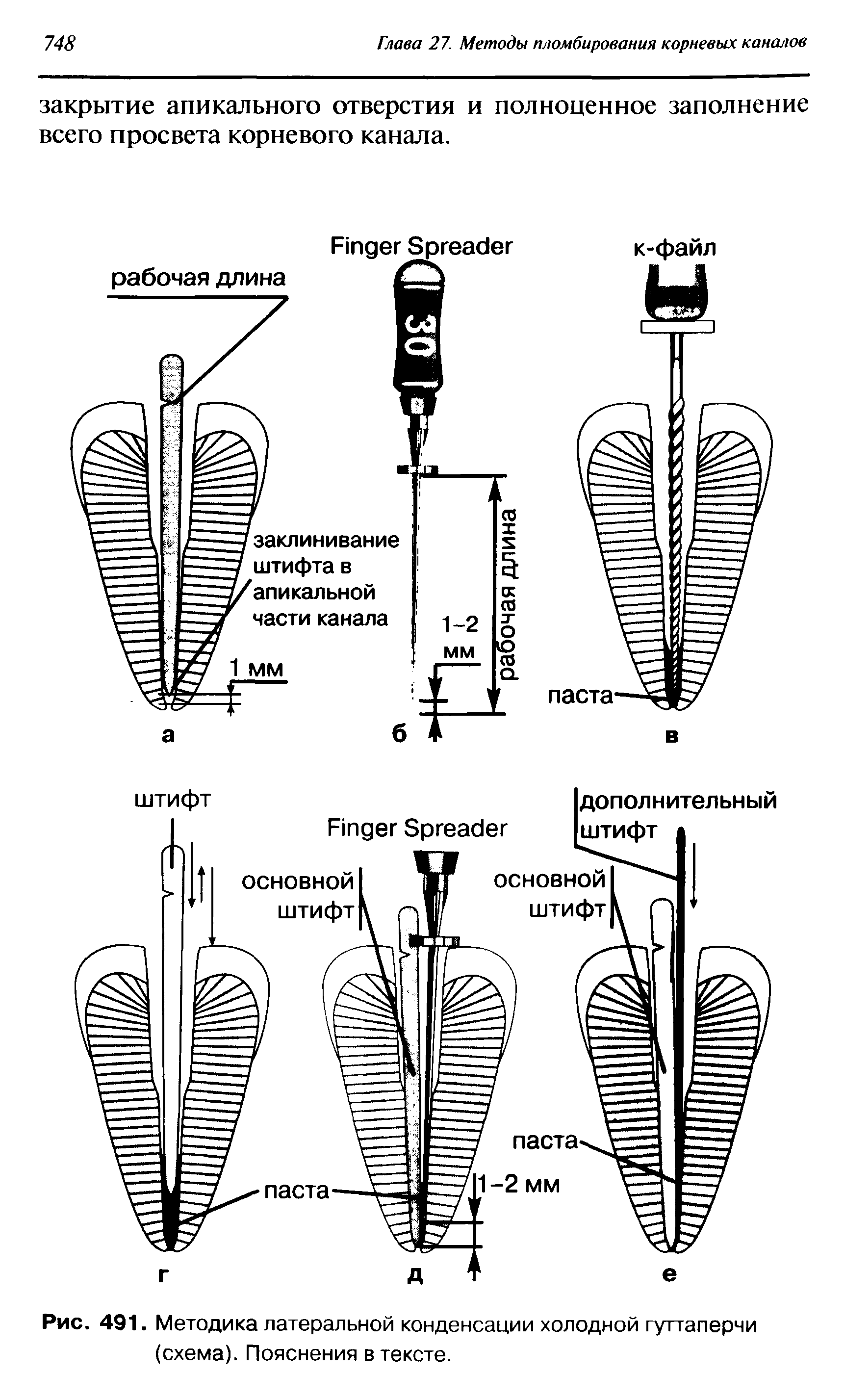 Рис. 491. Методика латеральной конденсации холодной гуттаперчи (схема). Пояснения в тексте.