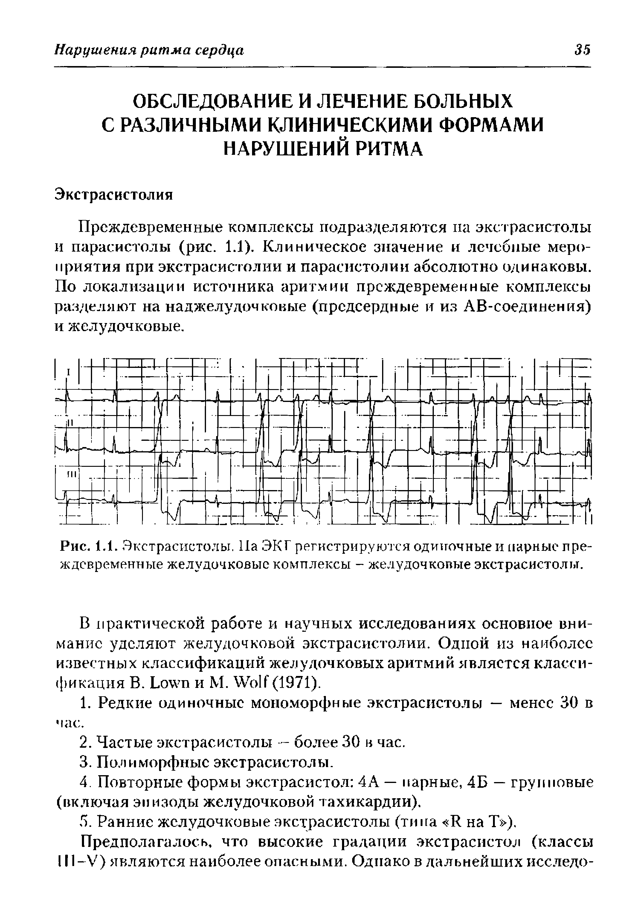 Рис. 1.1. Экстрасистолы. На ЭКГ регистрируются одиночные и парные преждевременные желудочковые комплексы - желудочковые экстрасистолы.