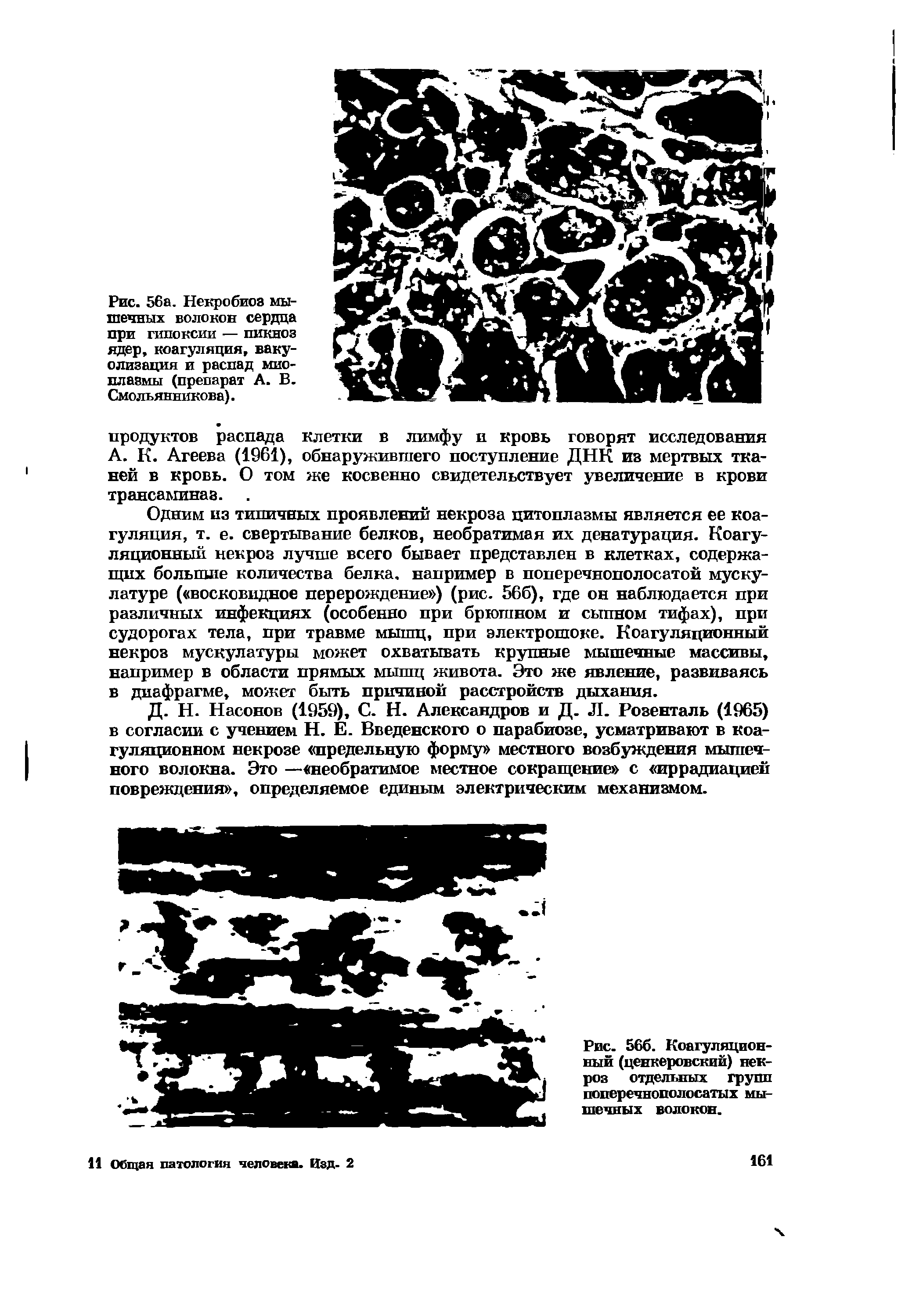 Рис. 566. Коагуляционный (ценкеровский) некроз отдельных групп поперечнополосатых мышечных волокон.