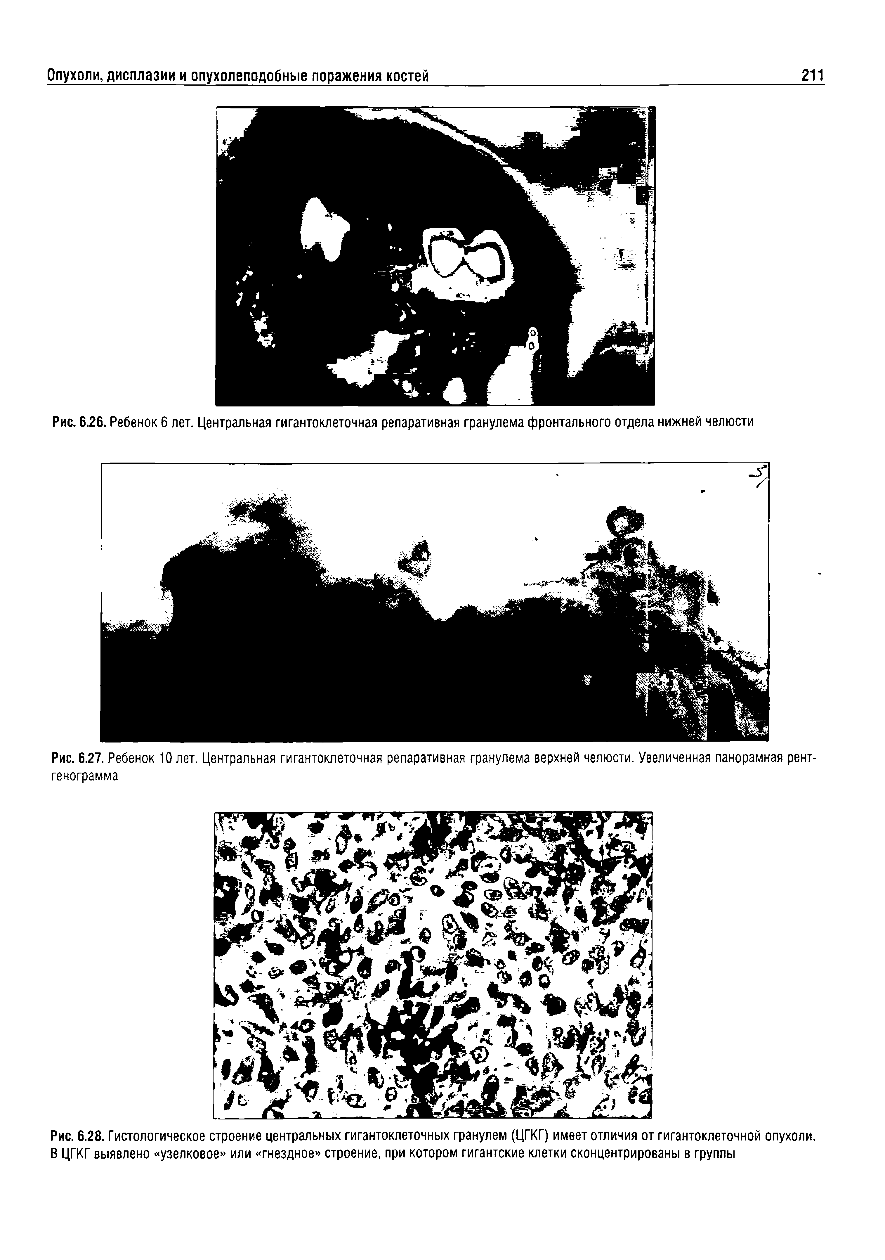 Рис. 6.28. Гистологическое строение центральных гигантоклеточных гранулем (ЦГКГ) имеет отличия от гигантоклеточной опухоли. В ЦГКГ выявлено узелковое или гнездное строение, при котором гигантские клетки сконцентрированы в группы...
