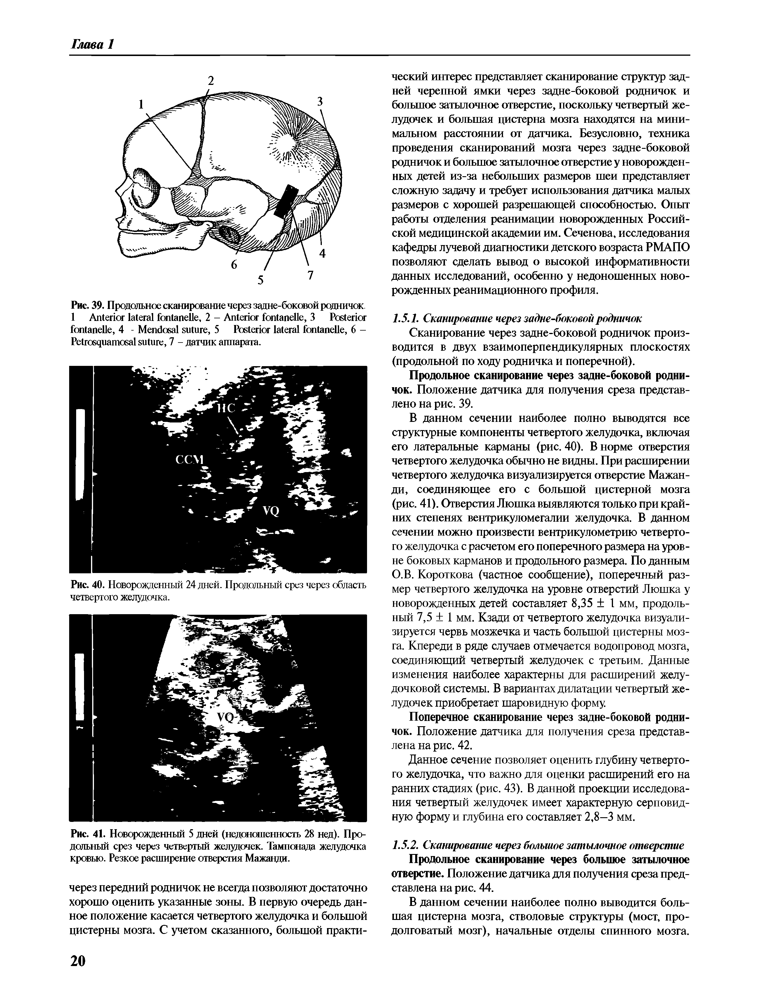 Рис. 39. Продольное сканирование через задне-боковой родничок. 1 A , 2 - A , 3 P , 4 - M , 5 P , 6 -P , 7 - датчик аппарата.