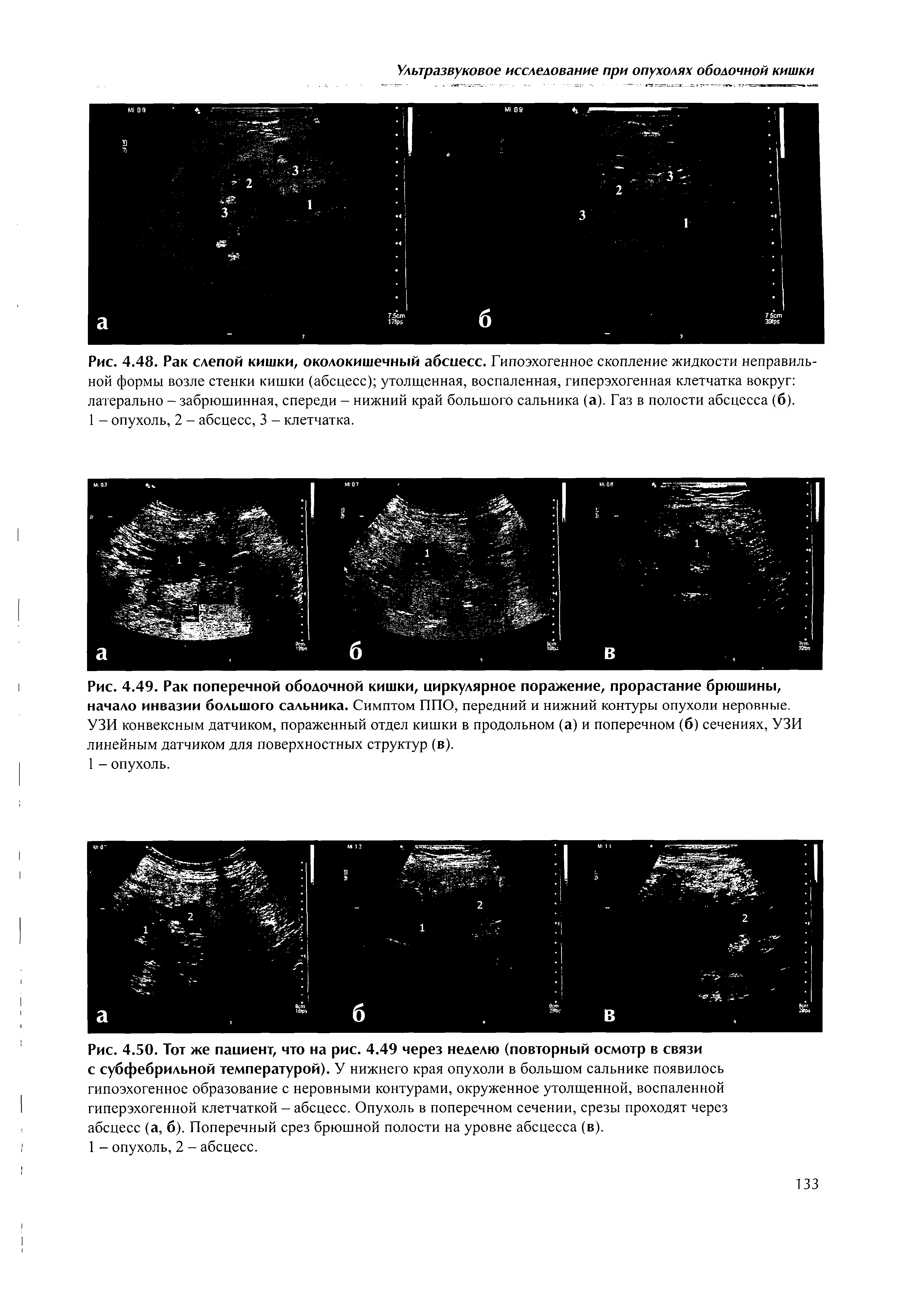 Рис. 4.48. Рак слепой кишки, околокишечный абсцесс. Гипоэхогенное скопление жидкости неправильной формы возле стенки кишки (абсцесс) утолщенная, воспаленная, гиперэхогенная клетчатка вокруг латерально - забрюшинная, спереди - нижний край большого сальника (а). Газ в полости абсцесса (б).