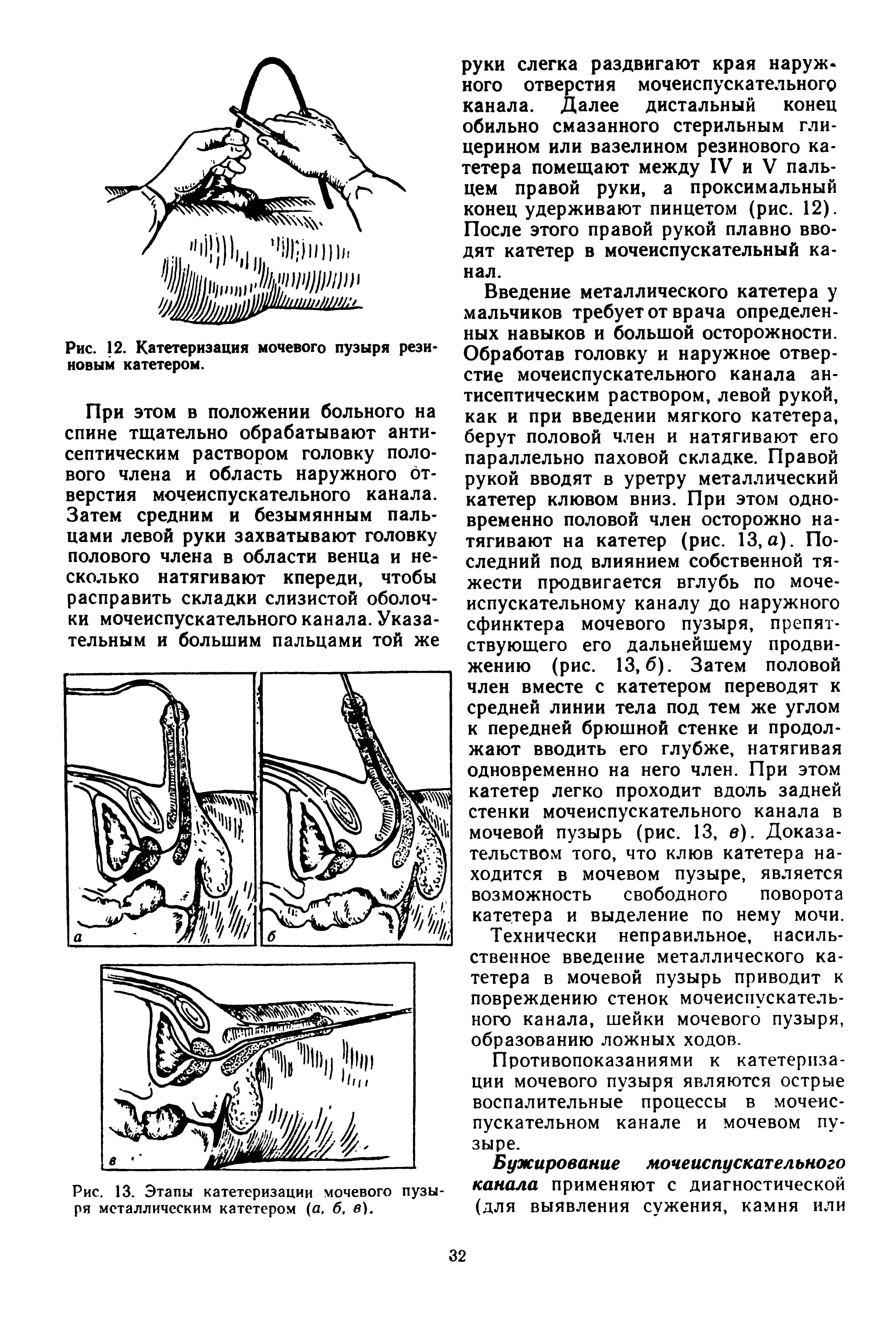 Рис. 13. Этапы катетеризации мочевого пузыря металлическим катетером (а, б, в).