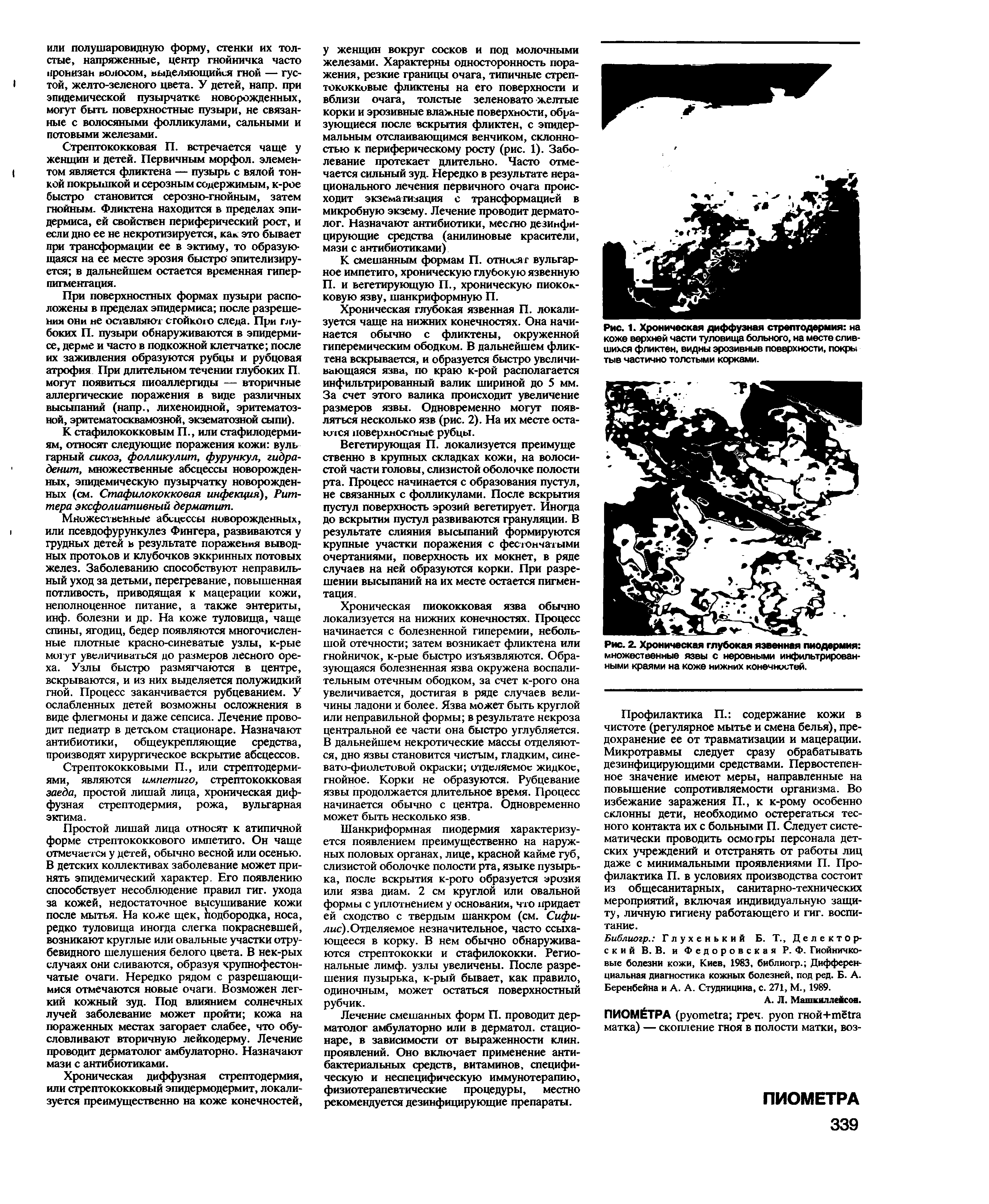 Рис. 2. Хроническая глубокая язвенная пиодермия множественные язвы с неровными инфильтрированными краями на коже нижних конечностей.