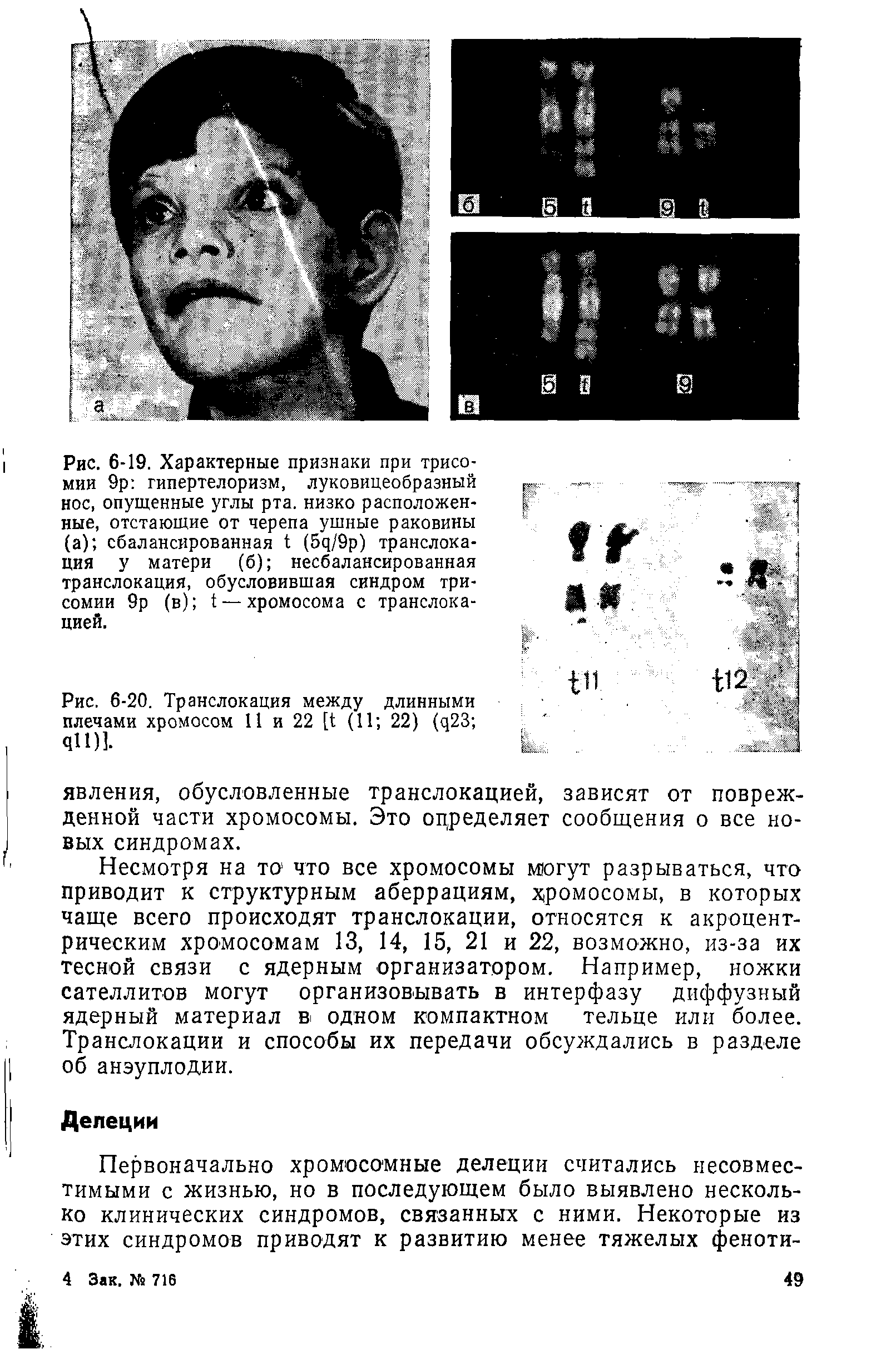 Рис. 6-19. Характерные признаки при трисомии 9р гипертелоризм, луковицеобразный нос, опущенные углы рта. низко расположенные, отстающие от черепа ушные раковины (а) сбалансированная 1 (5ц/9р) транслокация у матери (б) несбалансированная транслокация, обусловившая синдром трисомии 9р (в) 1 — хромосома с транслокацией.