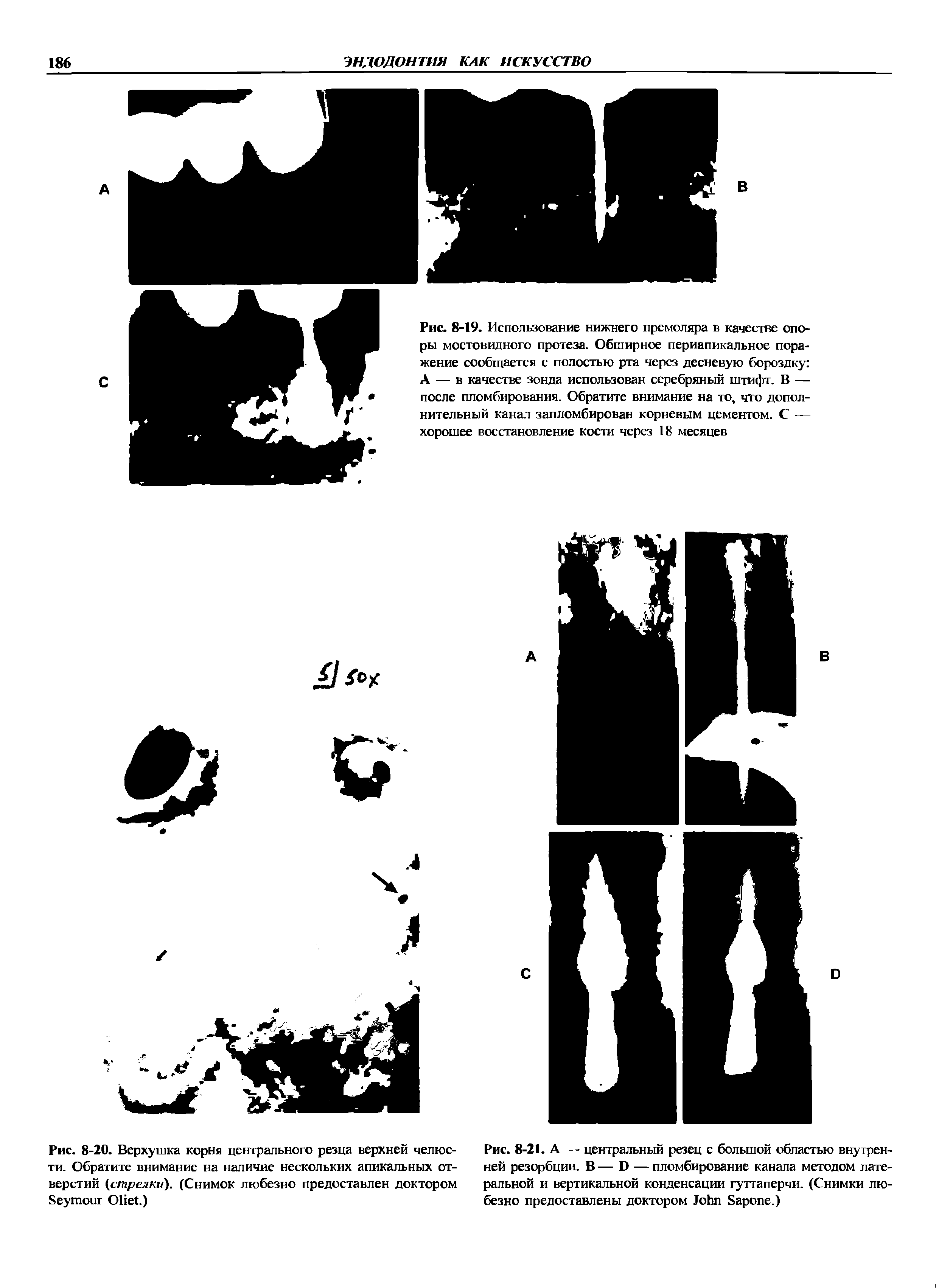 Рис. 8-21. А — центральный резец с большой областью внутренней резорбции. В — D — пломбирование канала методом латеральной и вертикальной конденсации гуттаперчи. (Снимки любезно предоставлены доктором J S .)...