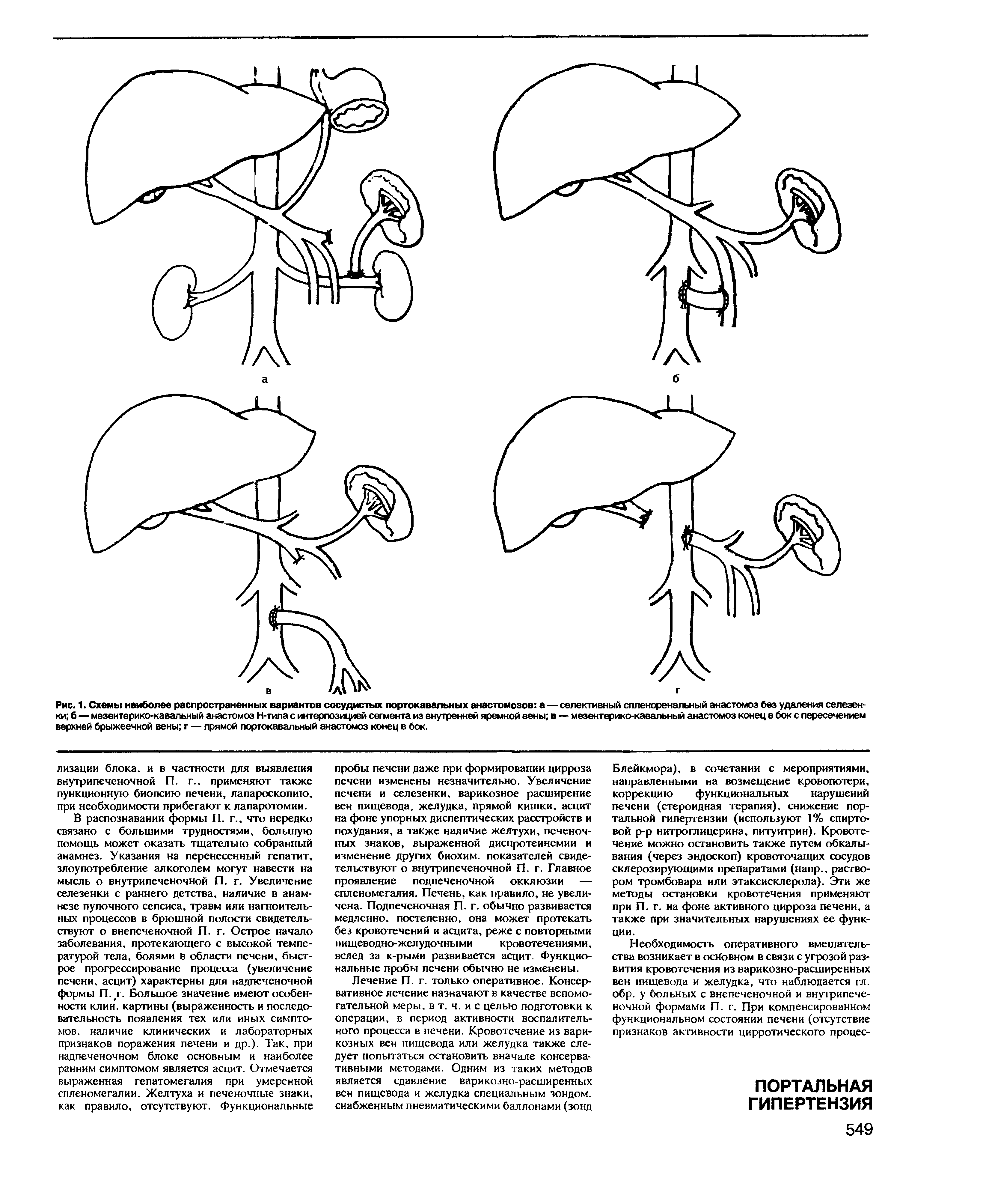 Рис. 1. Схемы наиболее распространенных вариантов сосудистых портокавальных анастомозов а — селективный спленоренальный анастомоз без удаления селезенки б — мезентерико-кавальный анастомоз Н-типа с интерпозицией сегмента из внутренней яремной вены в — мезентерико-кавальный анастомоз конец в бок с пересечением верхней брыжеечной вены г — прямой портокавальный анастомоз конец в бок.