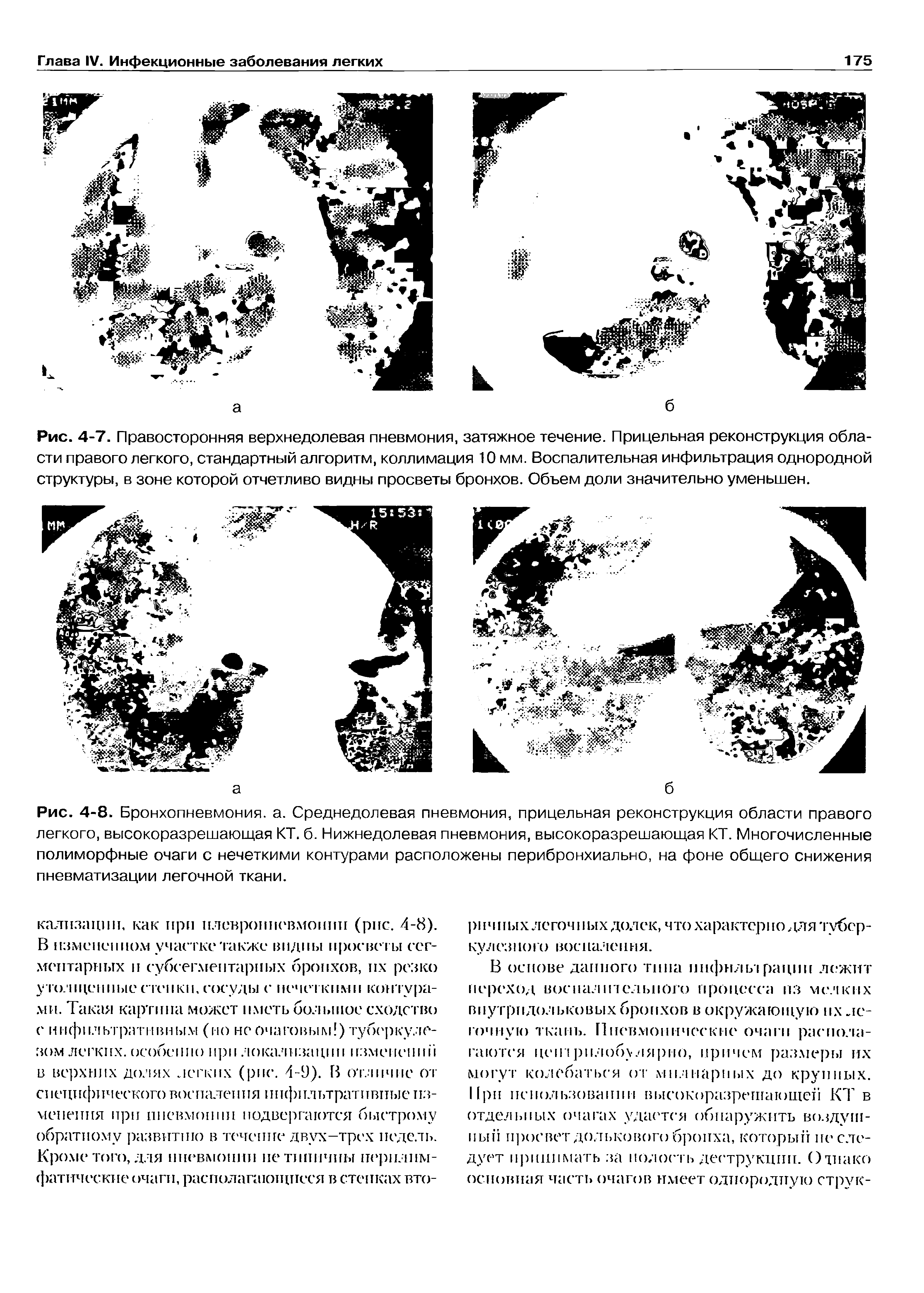 Рис. 4-7. Правосторонняя верхнедолевая пневмония, затяжное течение. Прицельная реконструкция области правого легкого, стандартный алгоритм, коллимация 10 мм. Воспалительная инфильтрация однородной структуры, в зоне которой отчетливо видны просветы бронхов. Объем доли значительно уменьшен.