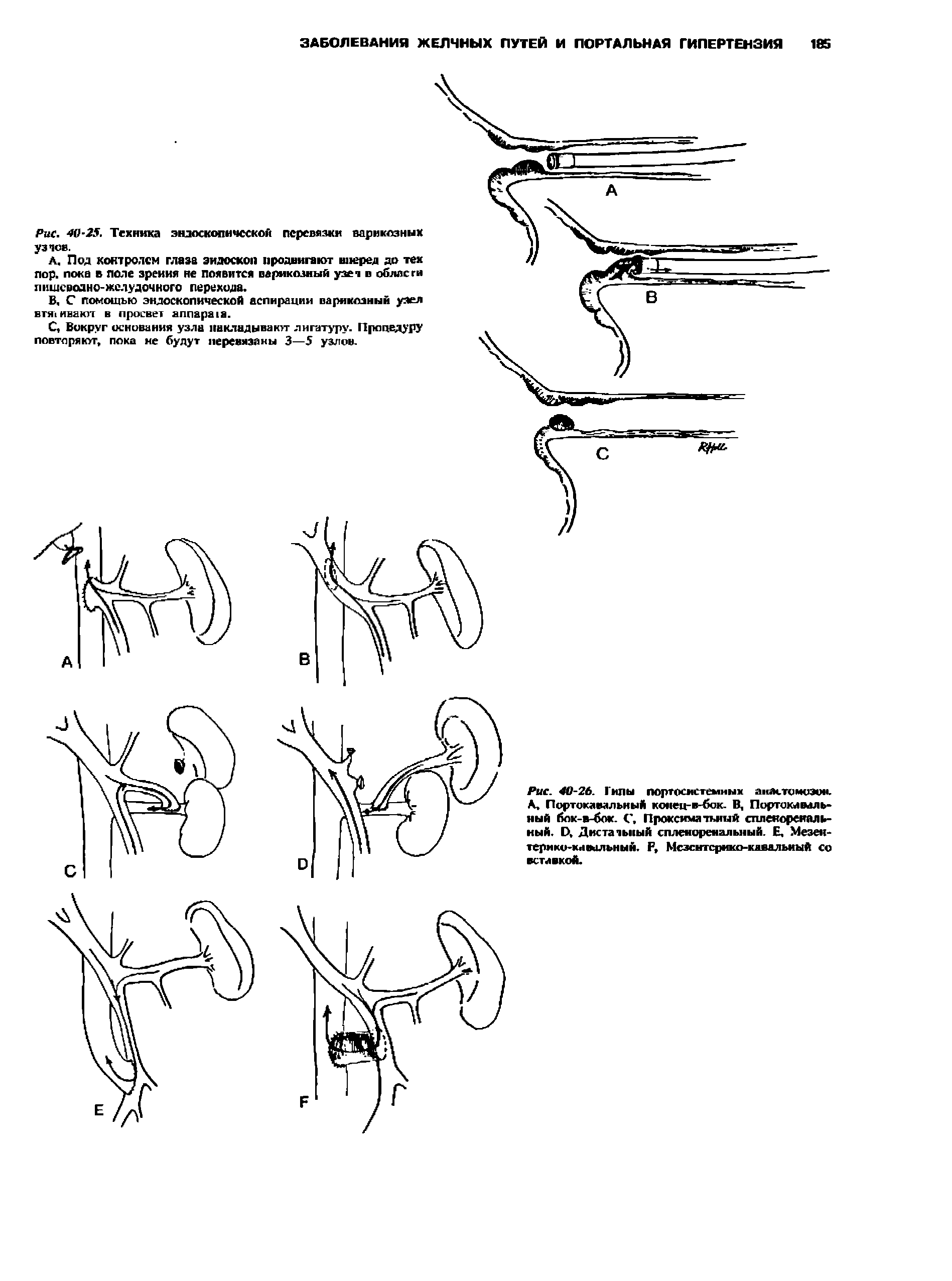 Рис. 40-26. Гилы портосистемных анастомозом. А, Портокавальный конец-в-бок. В, Портокавальный бок-в-бок. С. Проксима тъный спленоренальный. О Диета тьный спленоренальный. Е, Мезентерико-кавальный. Р, Мезентерико-кавальный со вставкой.