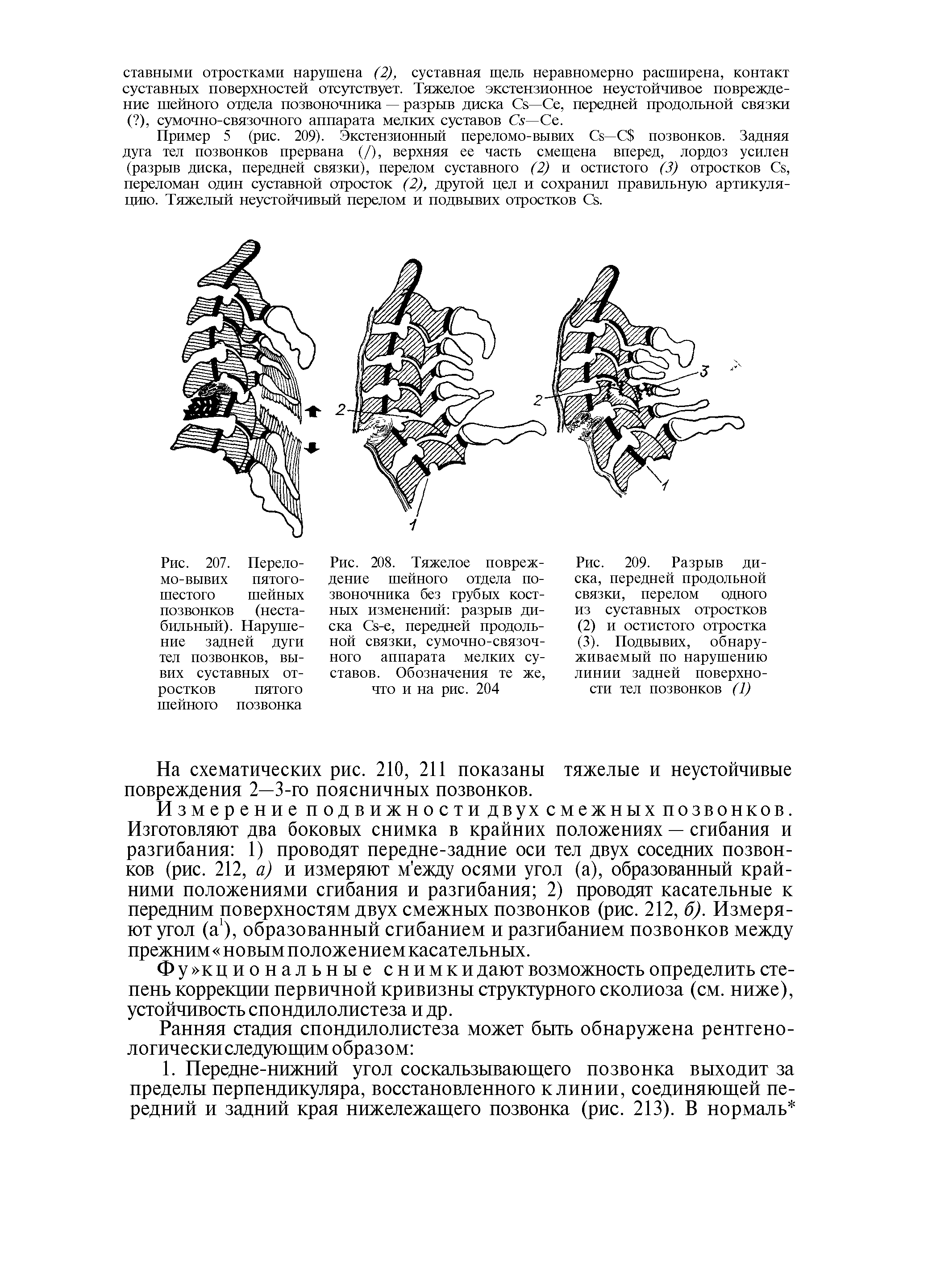 Рис. 209. Разрыв диска, передней продольной связки, перелом одного из суставных отростков...