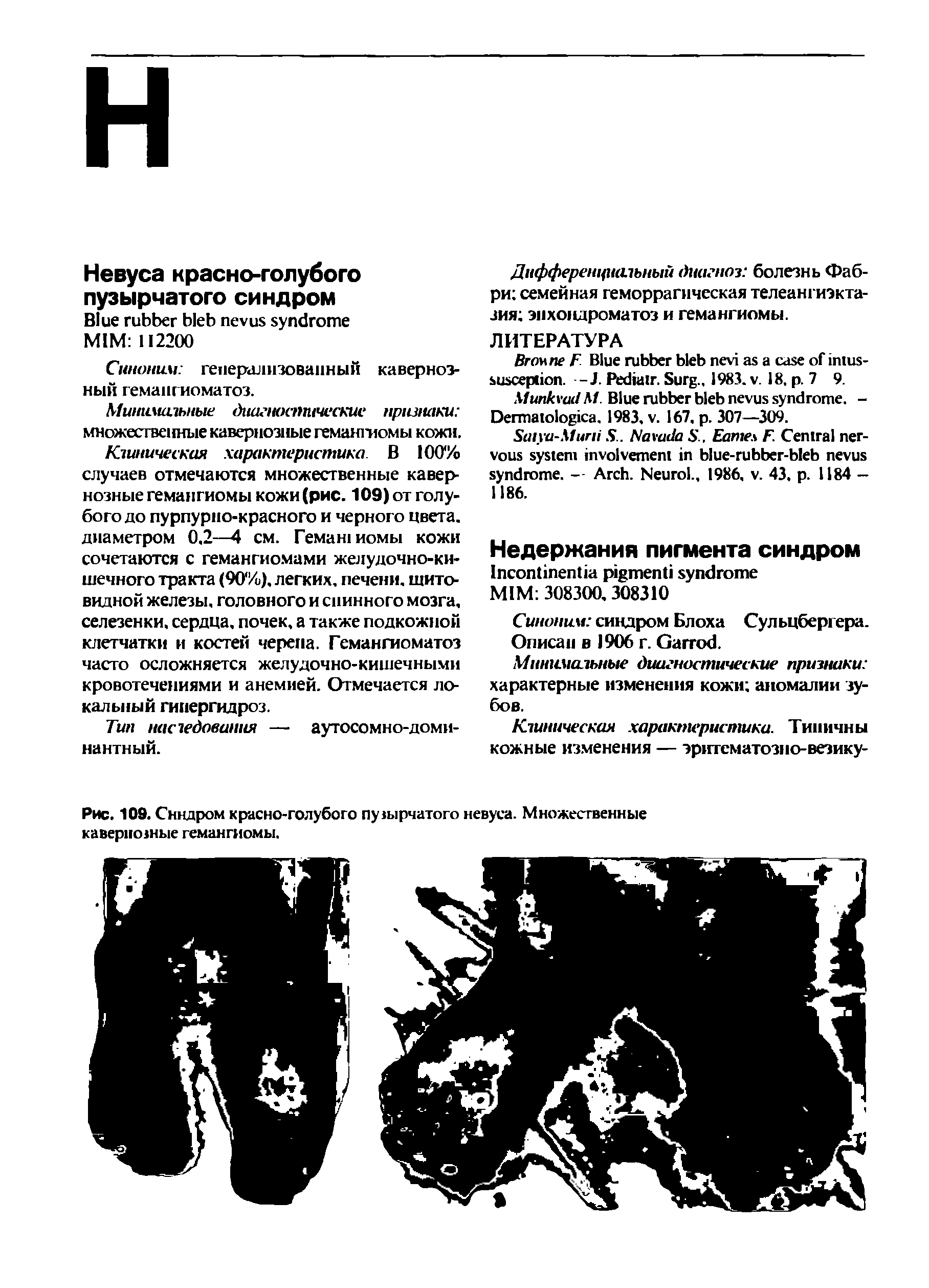 Рис. 109. Синдром красно-голубого пупырчатого невуса. Множественные кавернозные гемангиомы.