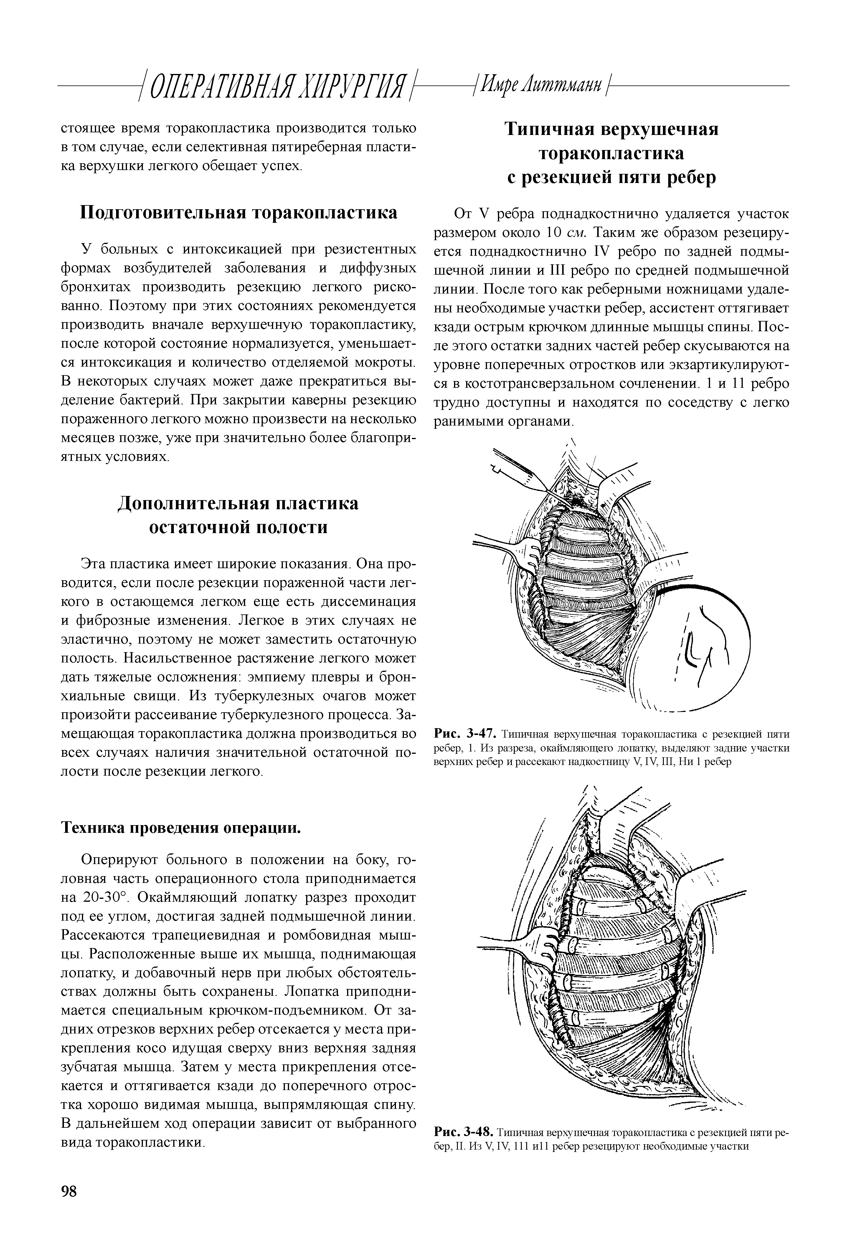 Рис. 3-47. Типичная верхушечная торакопластика с резекцией пяти ребер, 1. Из разреза, окаймляющего лопатку, выделяют задние участки верхних ребер и рассекают надкостницу V, IV, III, Ни 1 ребер...