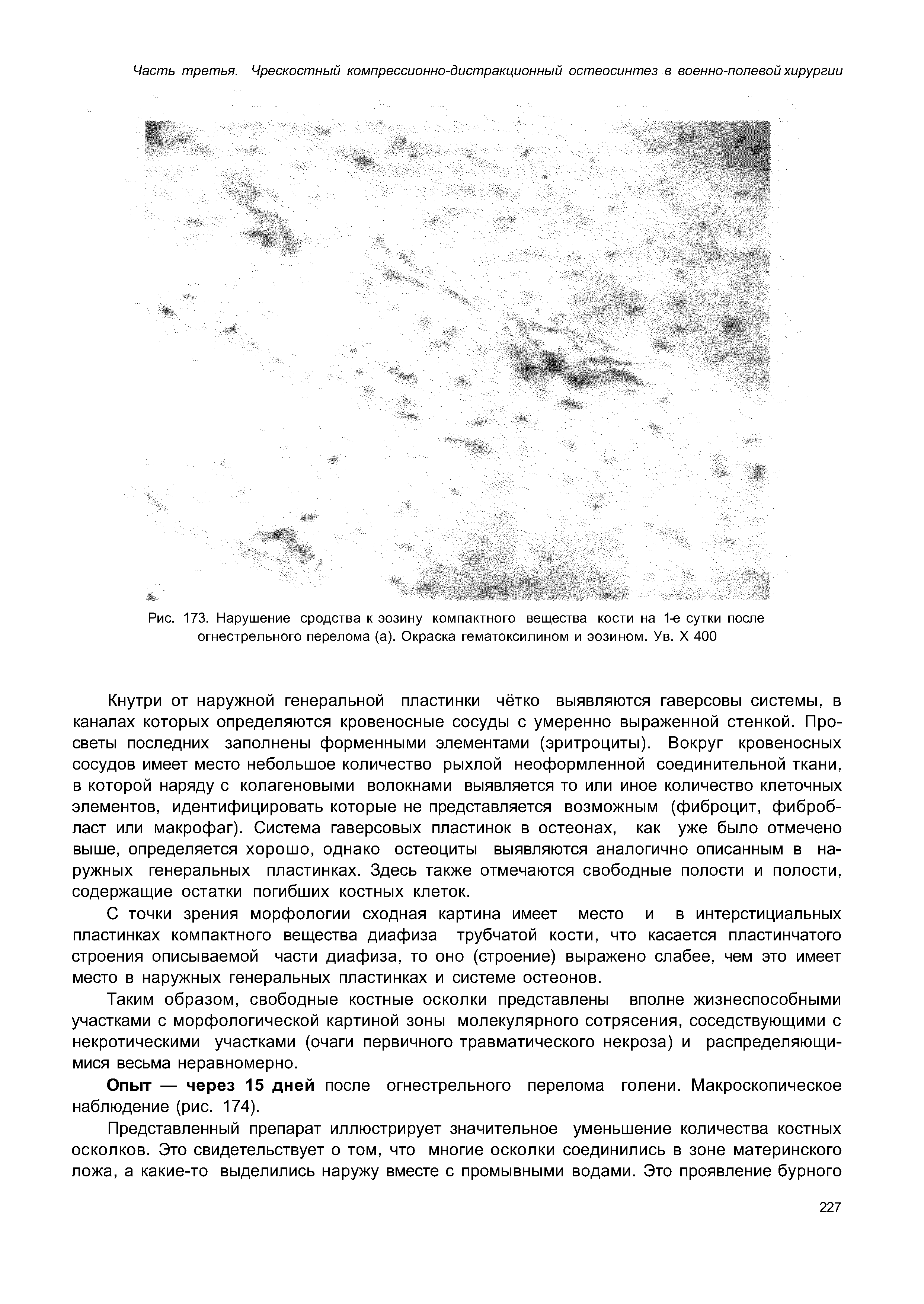 Рис. 173. Нарушение сродства к эозину компактного вещества кости на 1-е сутки после огнестрельного перелома (а). Окраска гематоксилином и эозином. Ув. X 400...