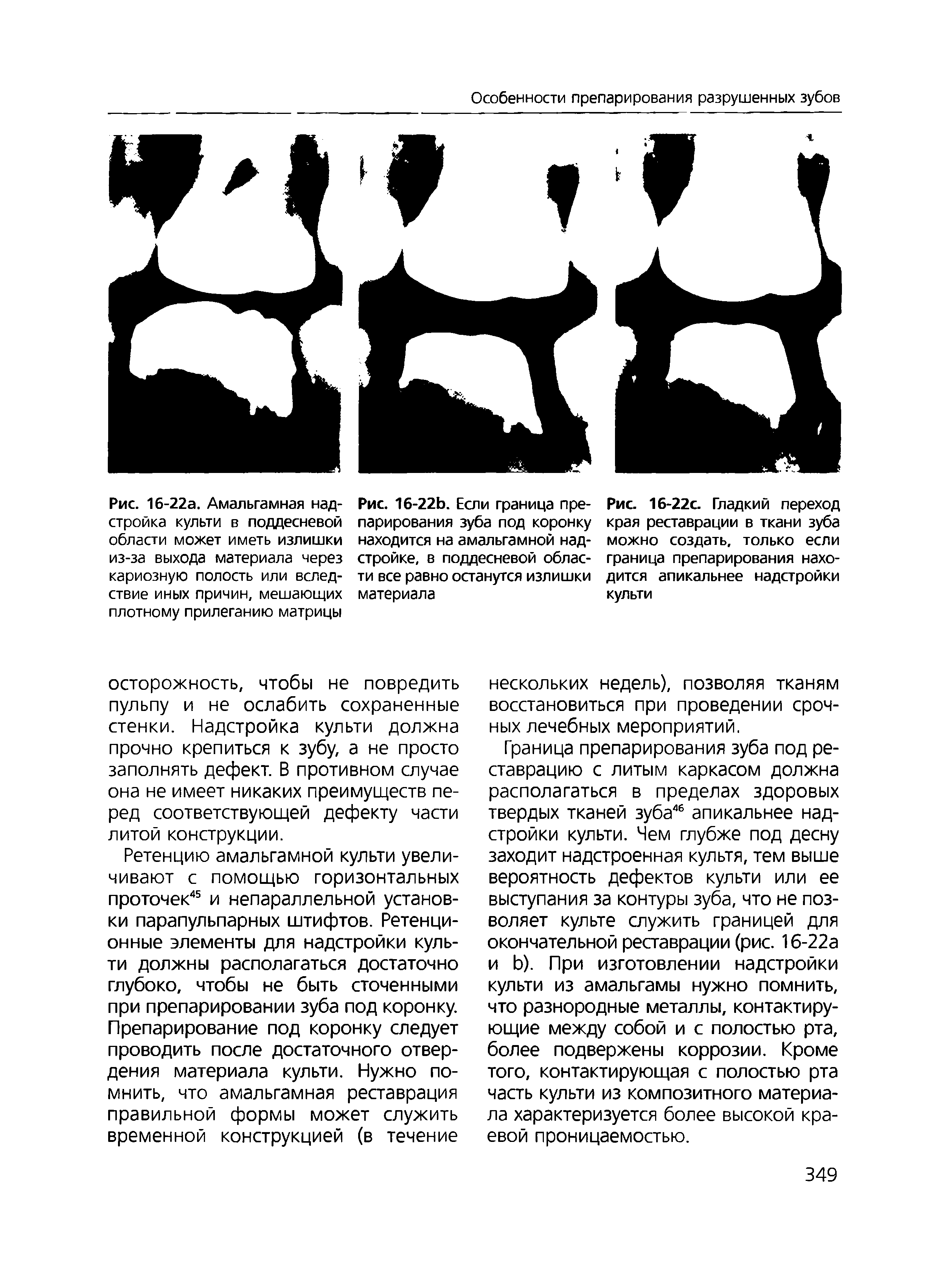 Рис. 16-22с. Гладкий переход края реставрации в ткани зуба можно создать, только если граница препарирования находится апикальнее надстройки культи...