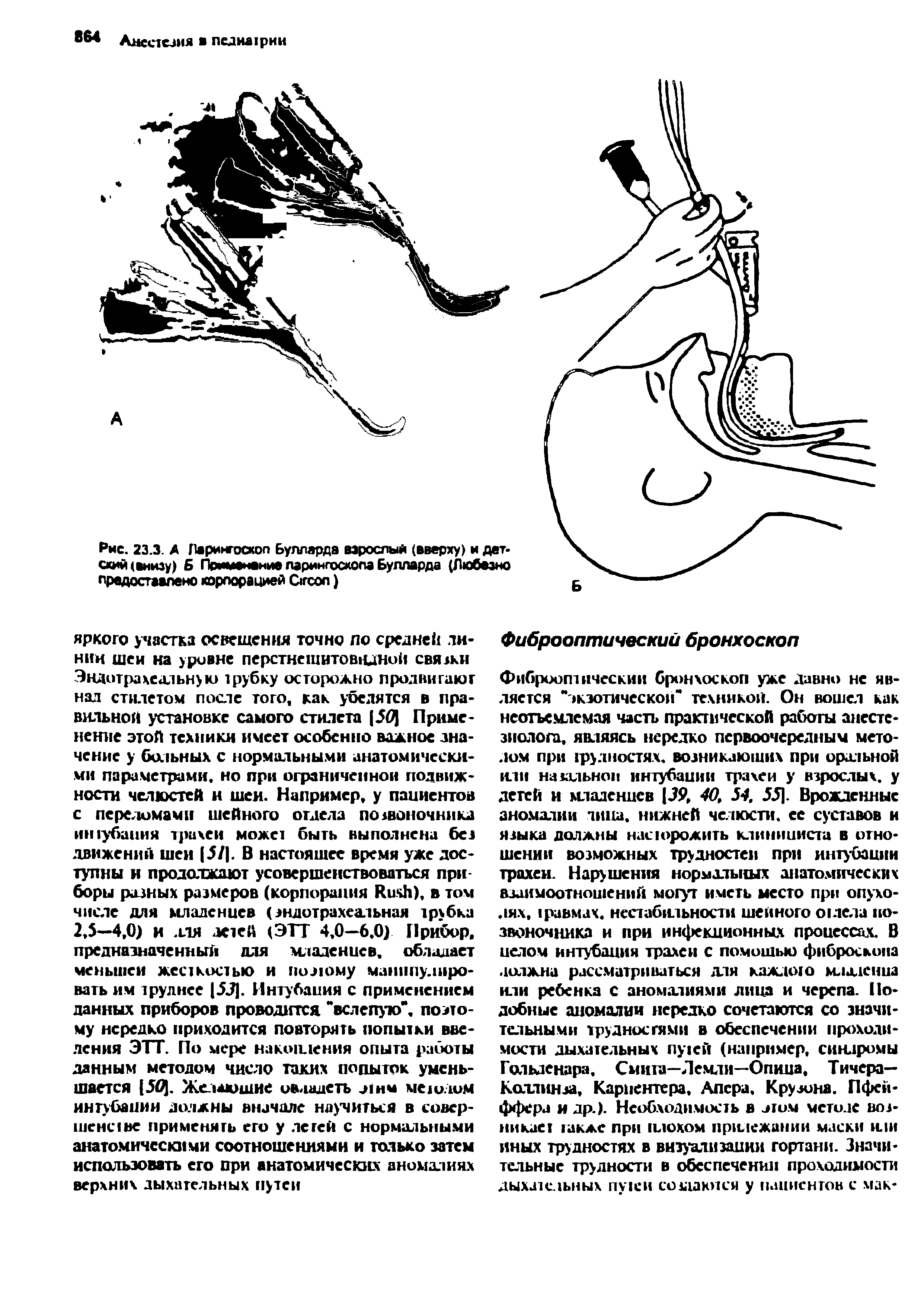 Рис. 23.3. А Ларингоскоп Булларда взрослый (вверху) и детский (внизу) Б Применение ларингоскопа Булларда (Любезно предоставлено корпорацией Сгсоп)...