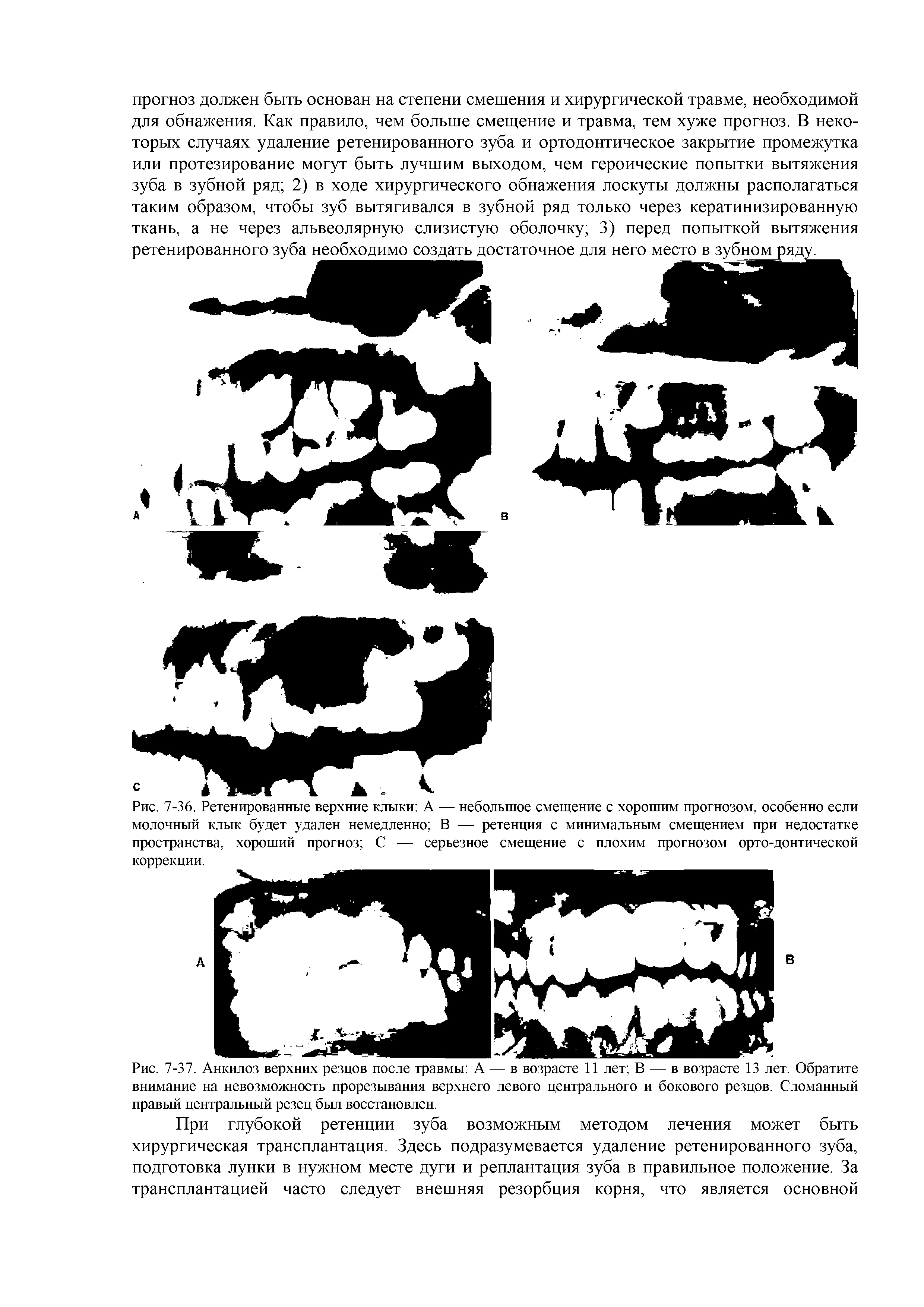 Рис. 7-36. Ретенированные верхние клыки А — небольшое смещение с хорошим прогнозом, особенно если молочный клык будет удален немедленно В — ретенция с минимальным смещением при недостатке пространства, хороший прогноз С — серьезное смещение с плохим прогнозом орто-донтической...