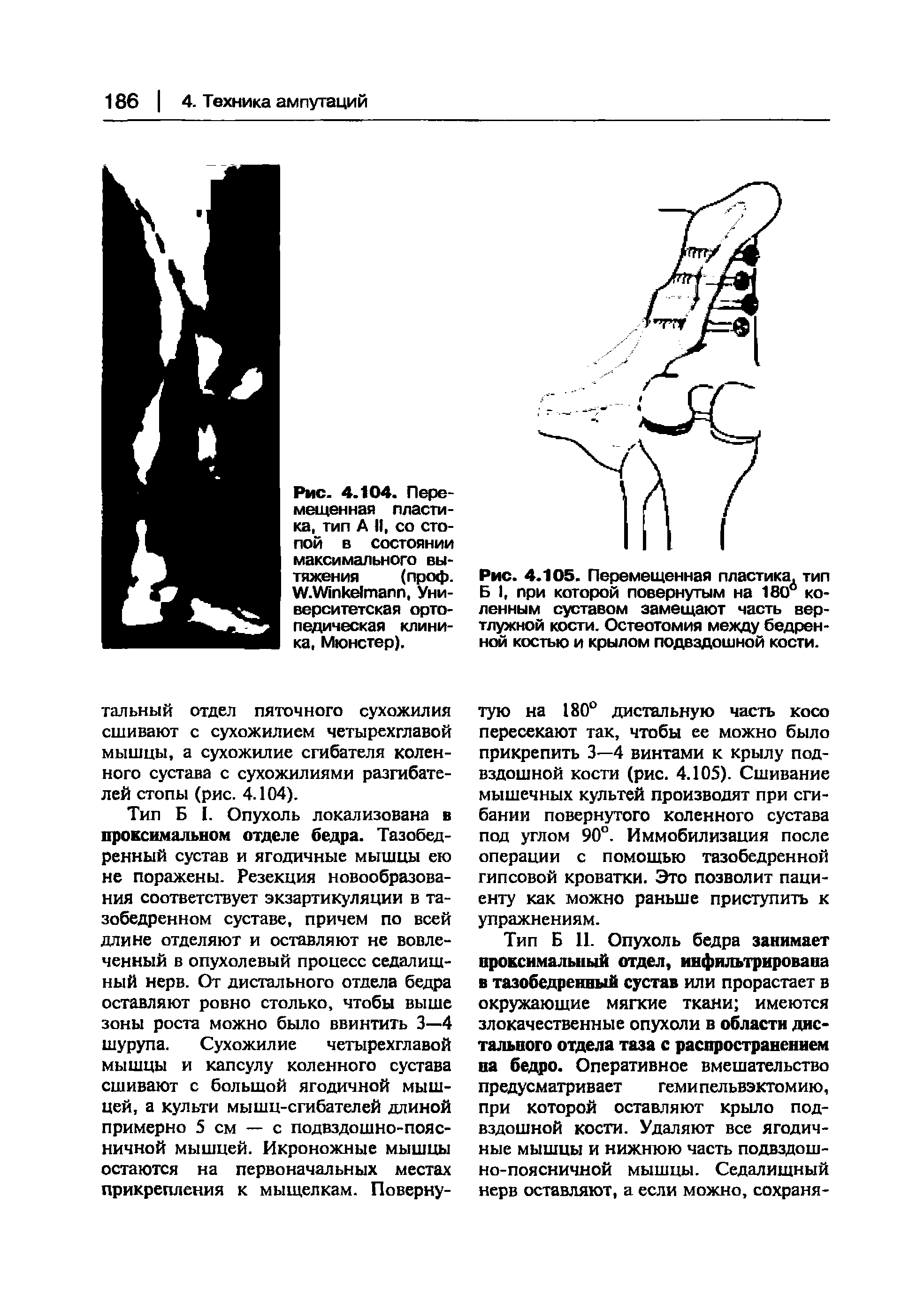 Рис. 4.105. Перемещенная пластика, тип Б I, при которой повернутым на 180° коленным суставом замещают часть вертлужной кости. Остеотомия между бедренной костью и крылом подвздошной кости.