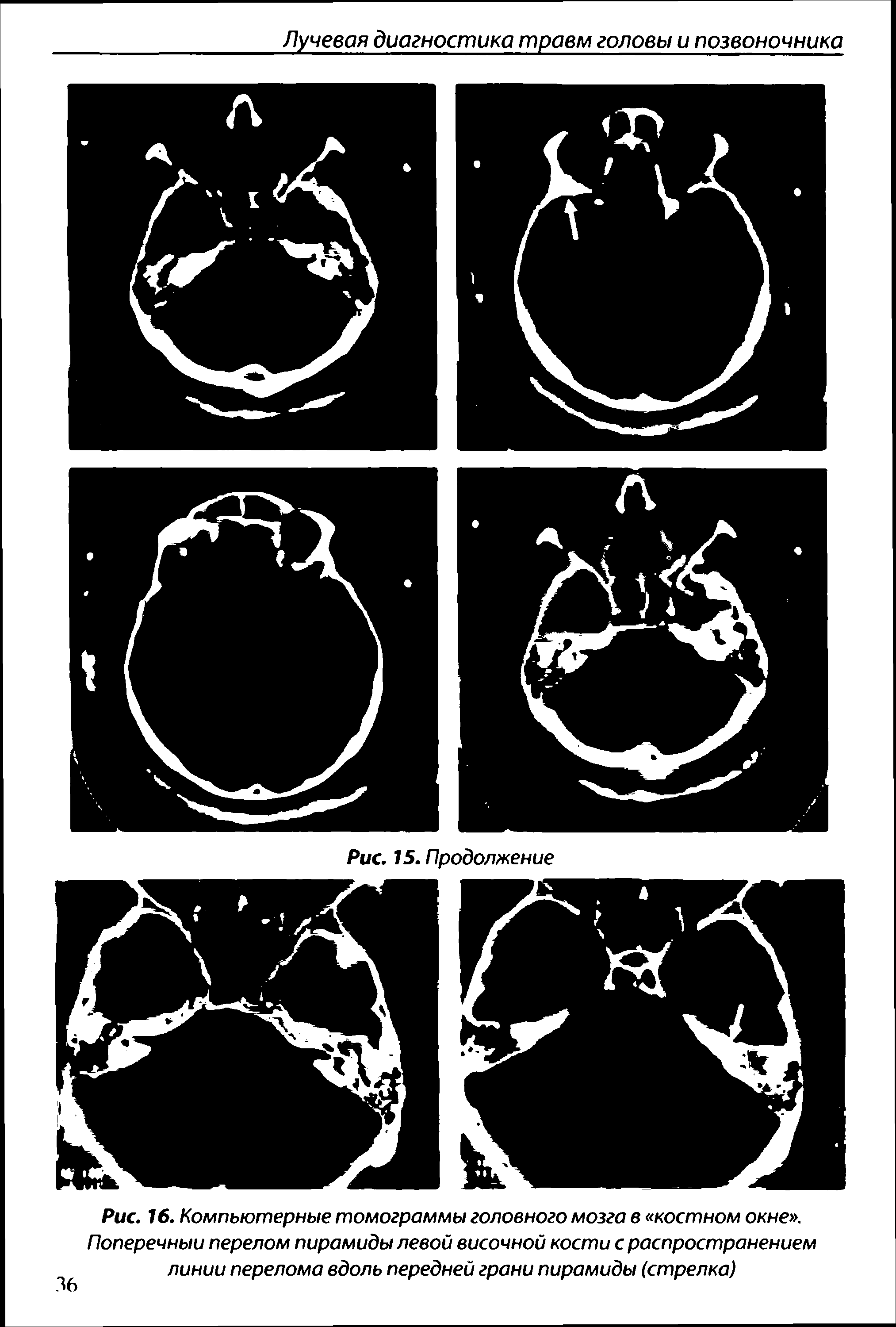 Рис. 16. Компьютерные томограммы головного мозга в костном окне . Поперечный перелом пирамиды левой височной кости с распространением линии перелома вдоль передней грани пирамиды (стрелка)...