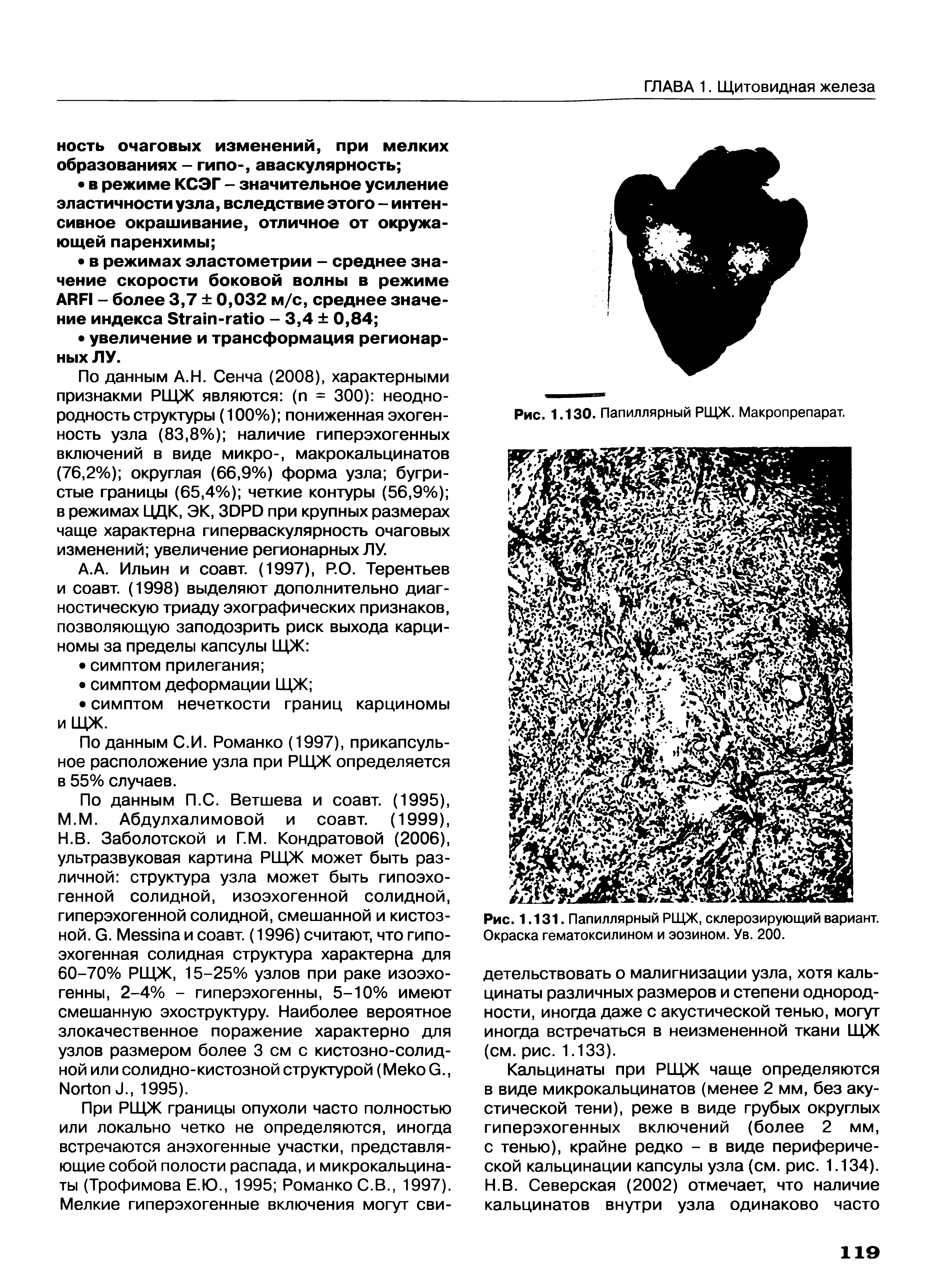 Рис. 1.131. Папиллярный РЩЖ, склерозирующий вариант. Окраска гематоксилином и эозином. Ув. 200.