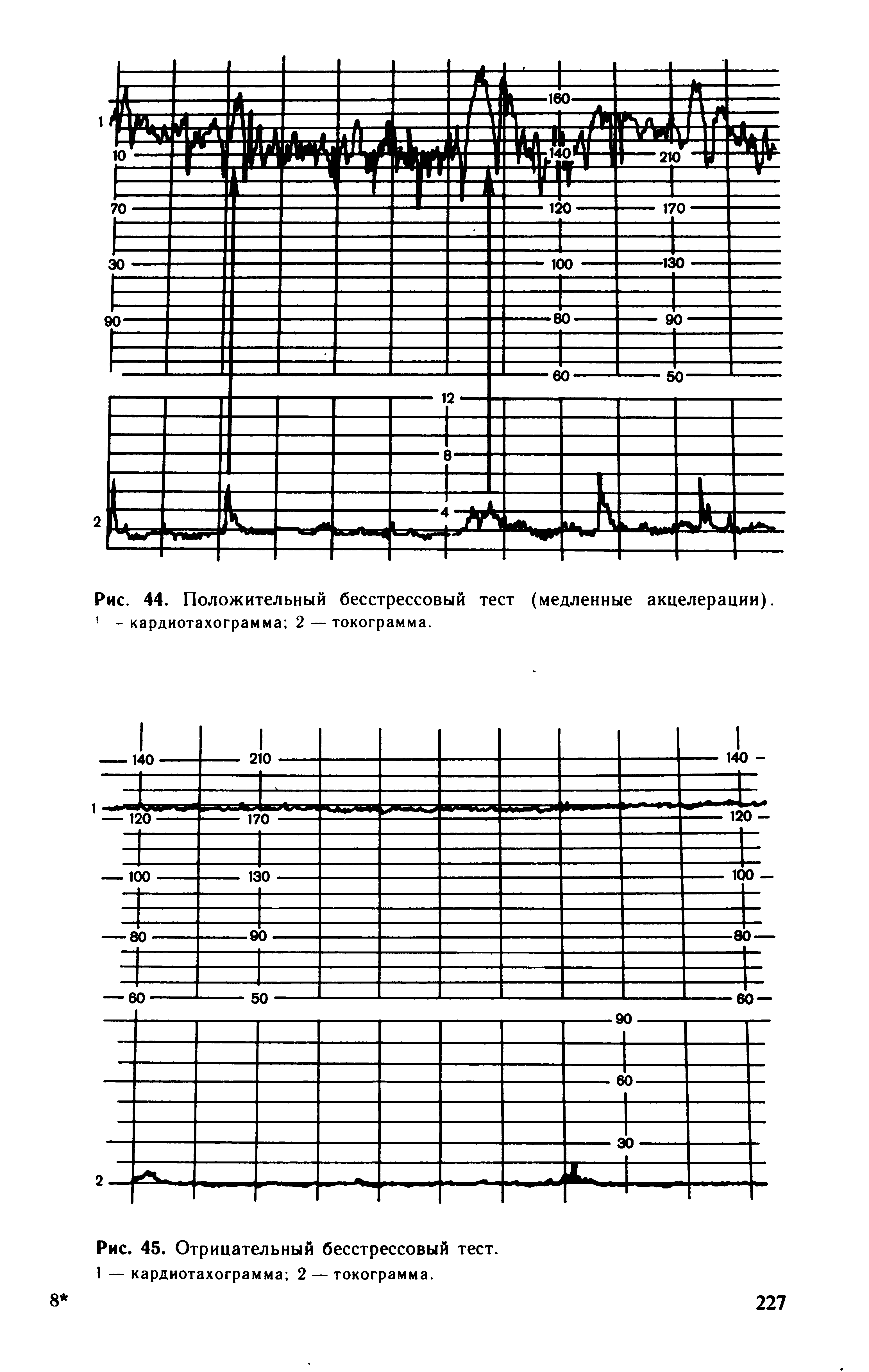 Рис. 44. Положительный бесстрессовый тест (медленные акцелерации). - кардиотахограмма 2 — токограмма.